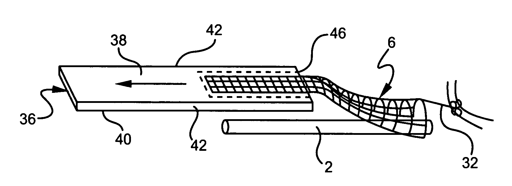 Device for treating carpal tunnel syndrome