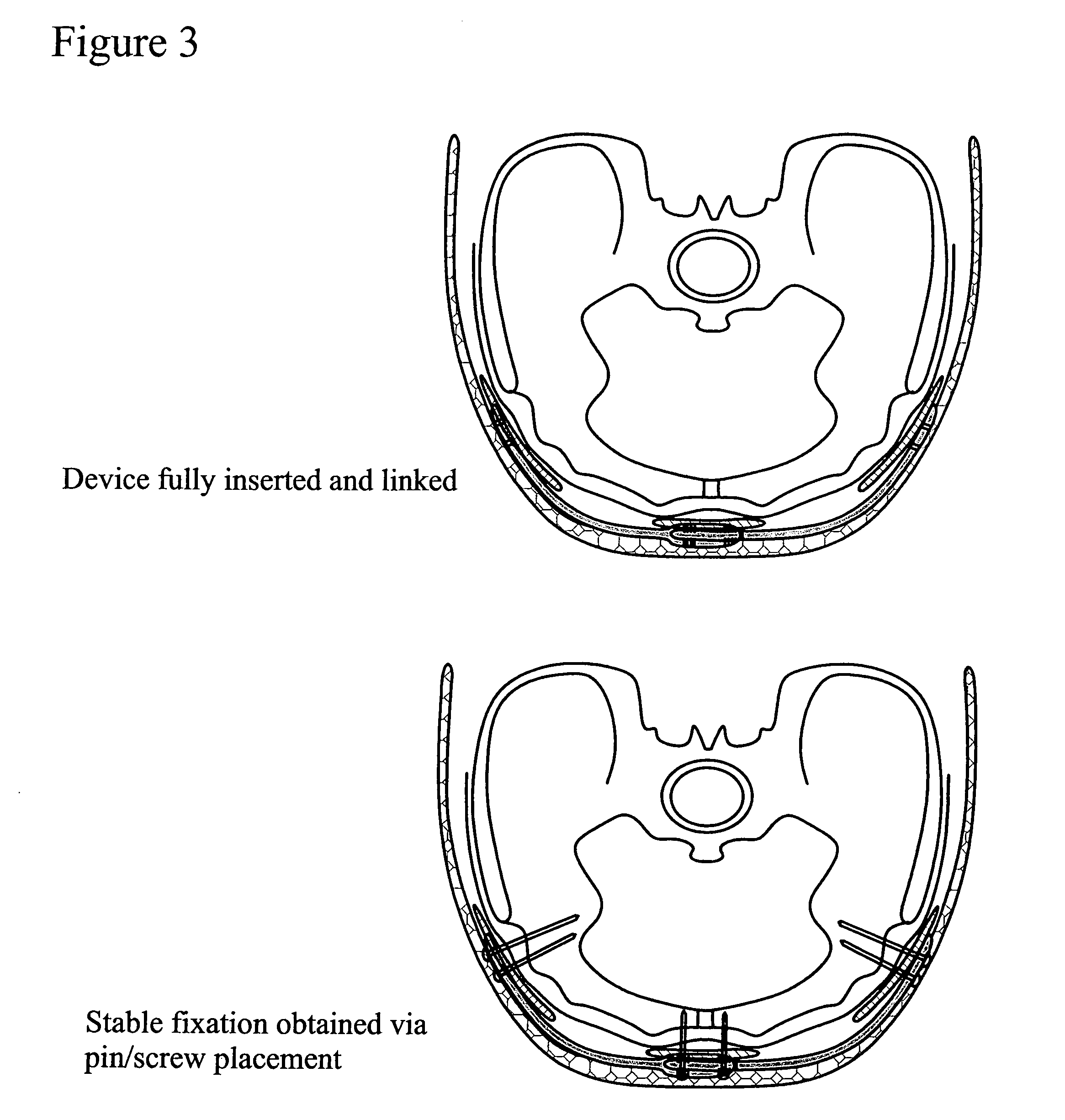 Device and method for less invasive surgical stabilization of pelvic fractures