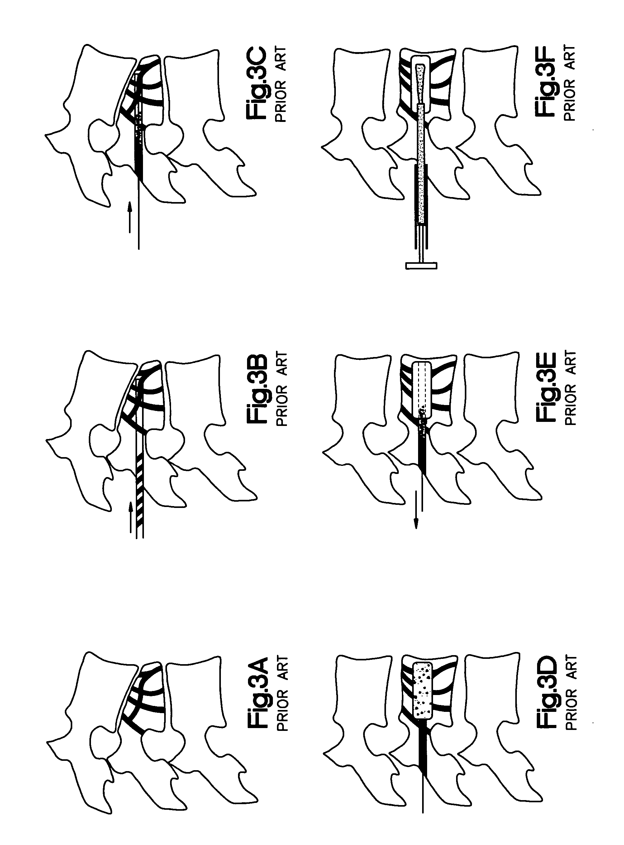 Apparatus and methods for treating bone
