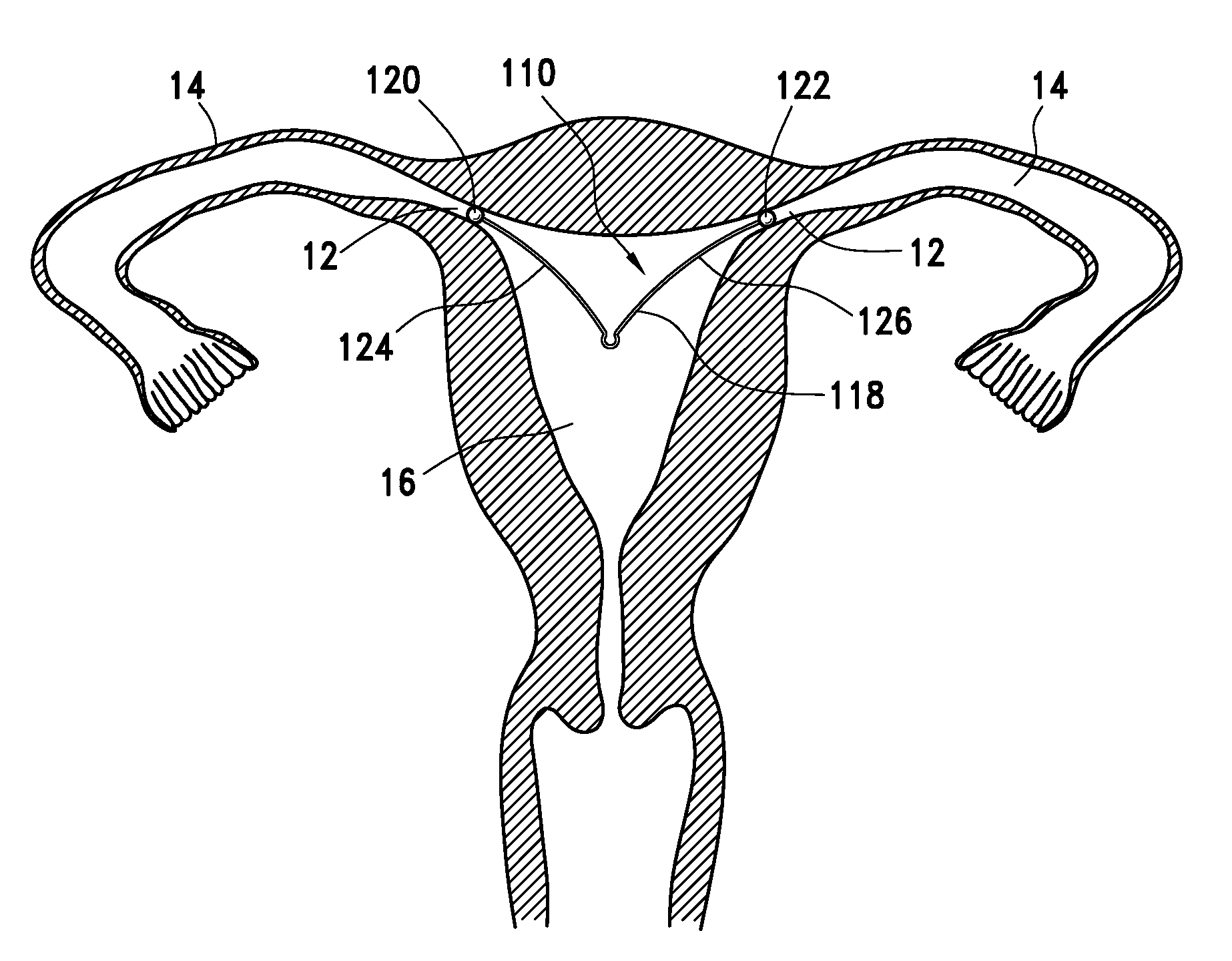 Intrauterine fallopian tube occlusion device