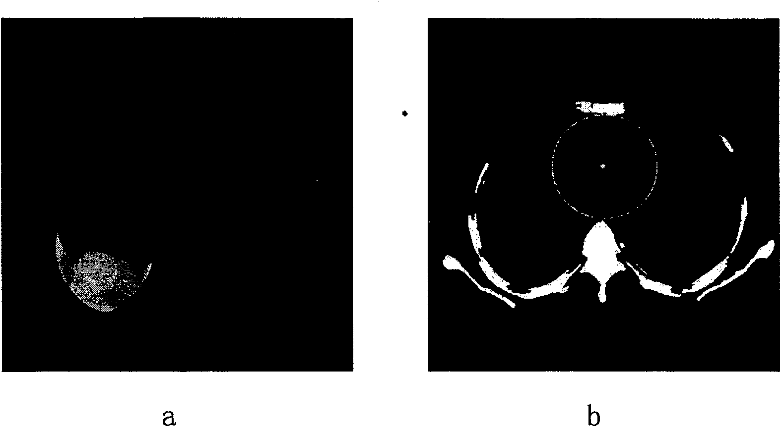 Semi-automatic partition method of lung CT image focus