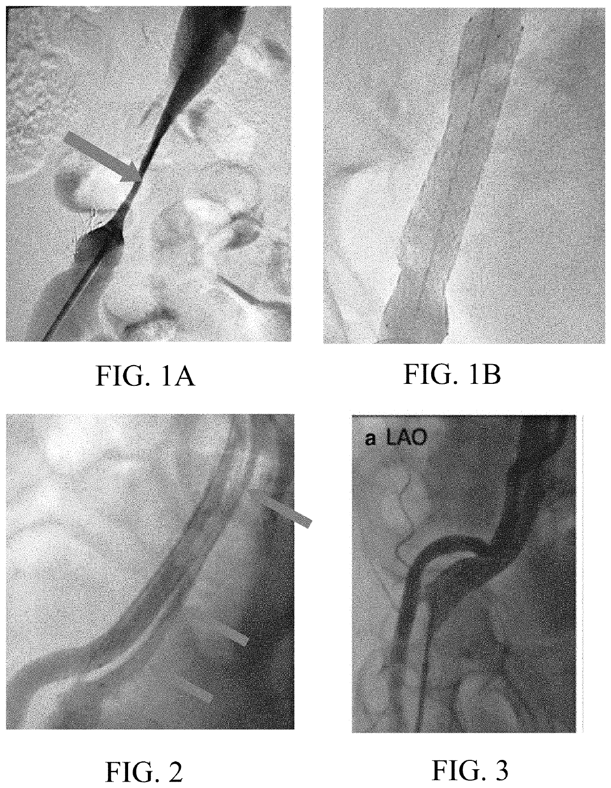 Systems and methods for treating venous compression/obstruction syndromes