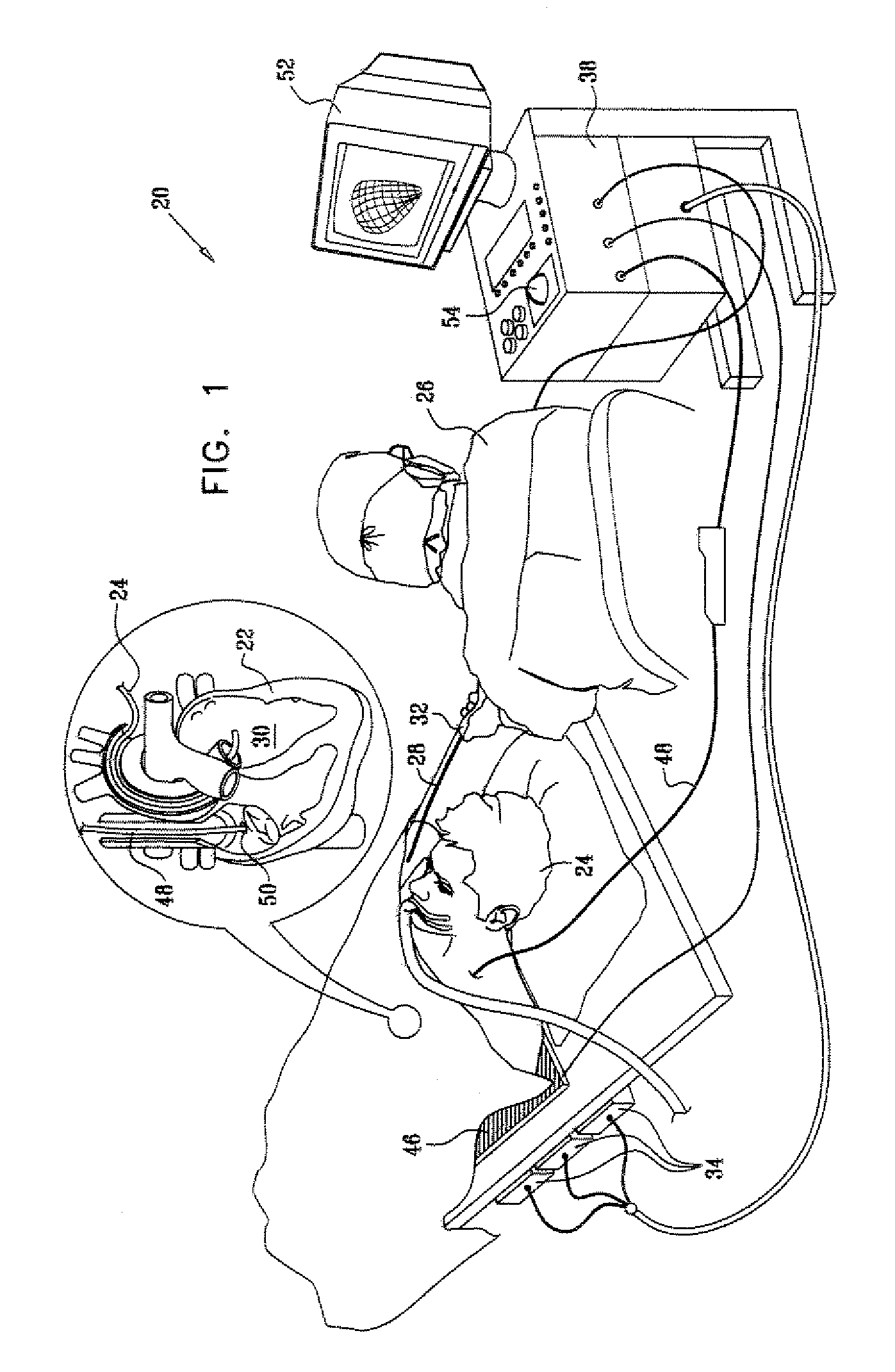 Intracorporeal location system with movement compensation