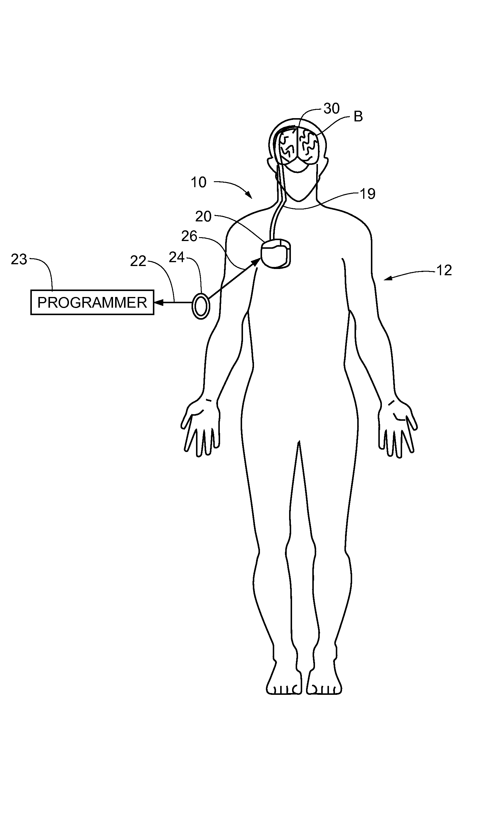 Method and apparatus for detection of nervous system disorders