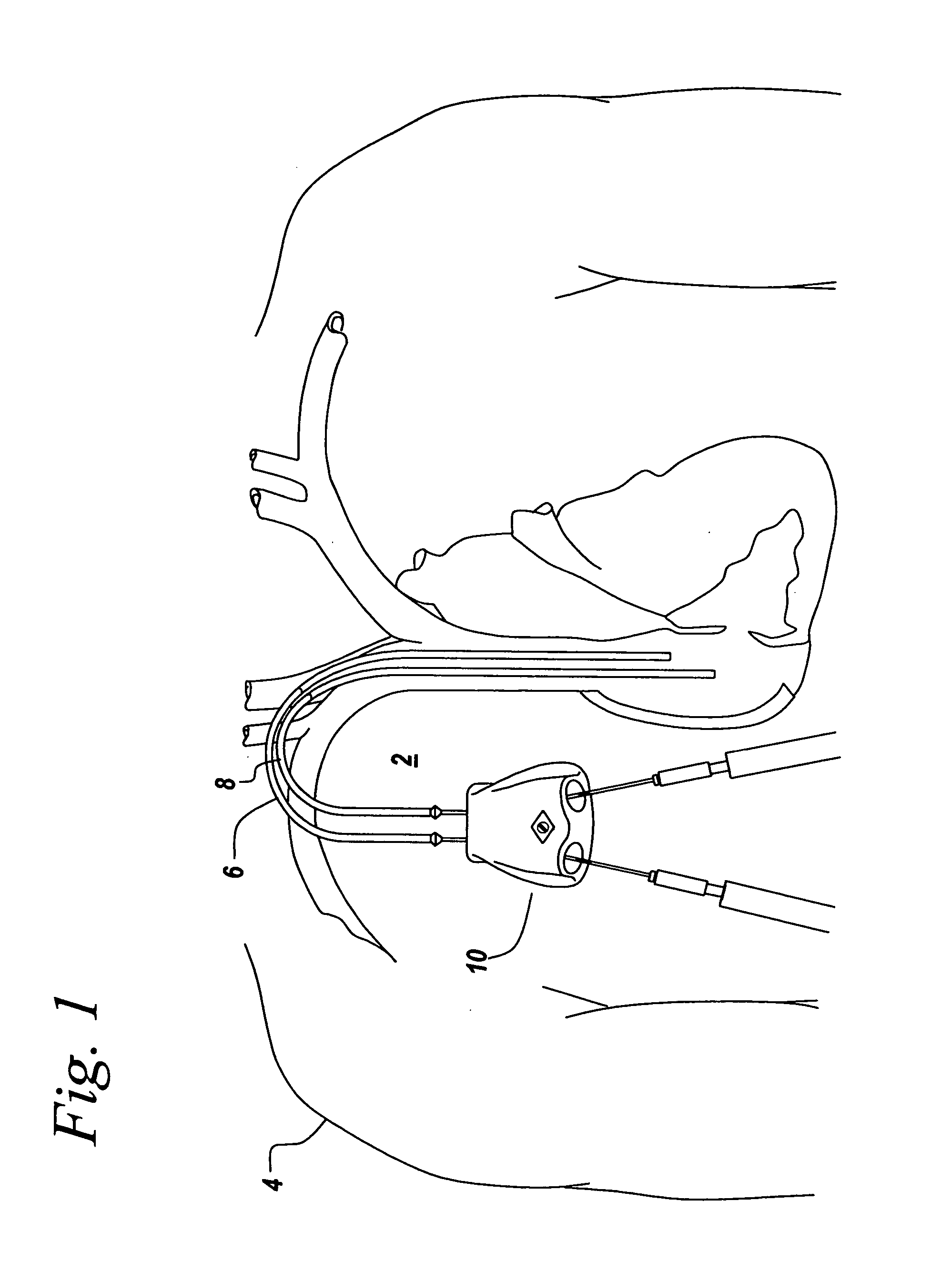 Subcutaneous needle connection system