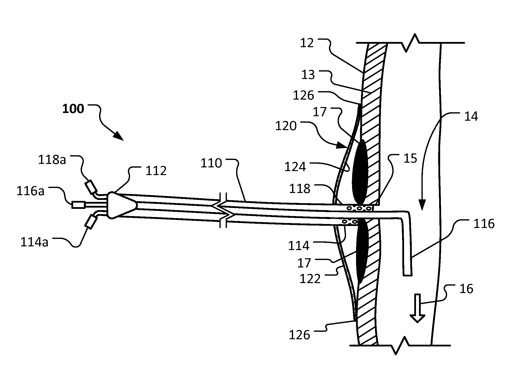 Enterocutaneous fistula treatment