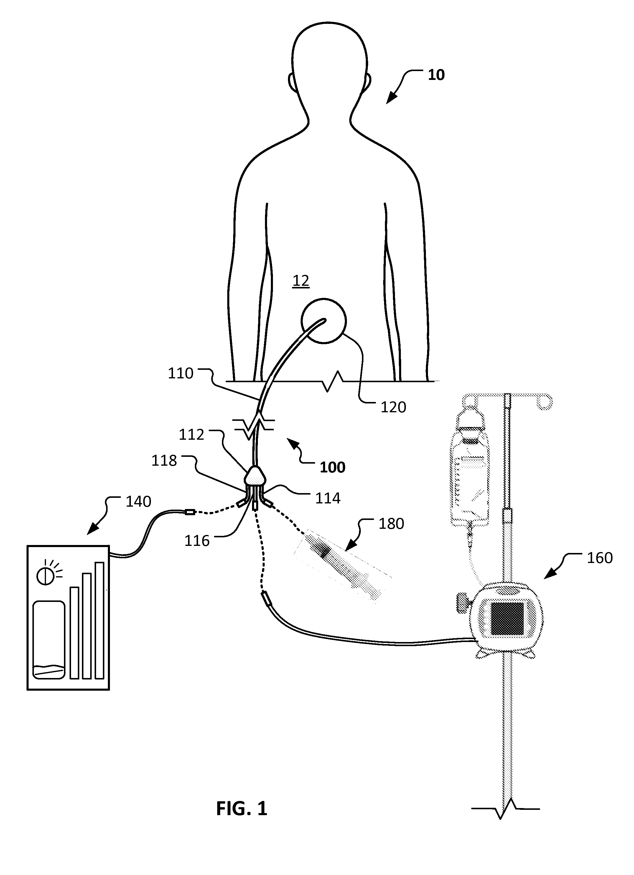 Enterocutaneous fistula treatment