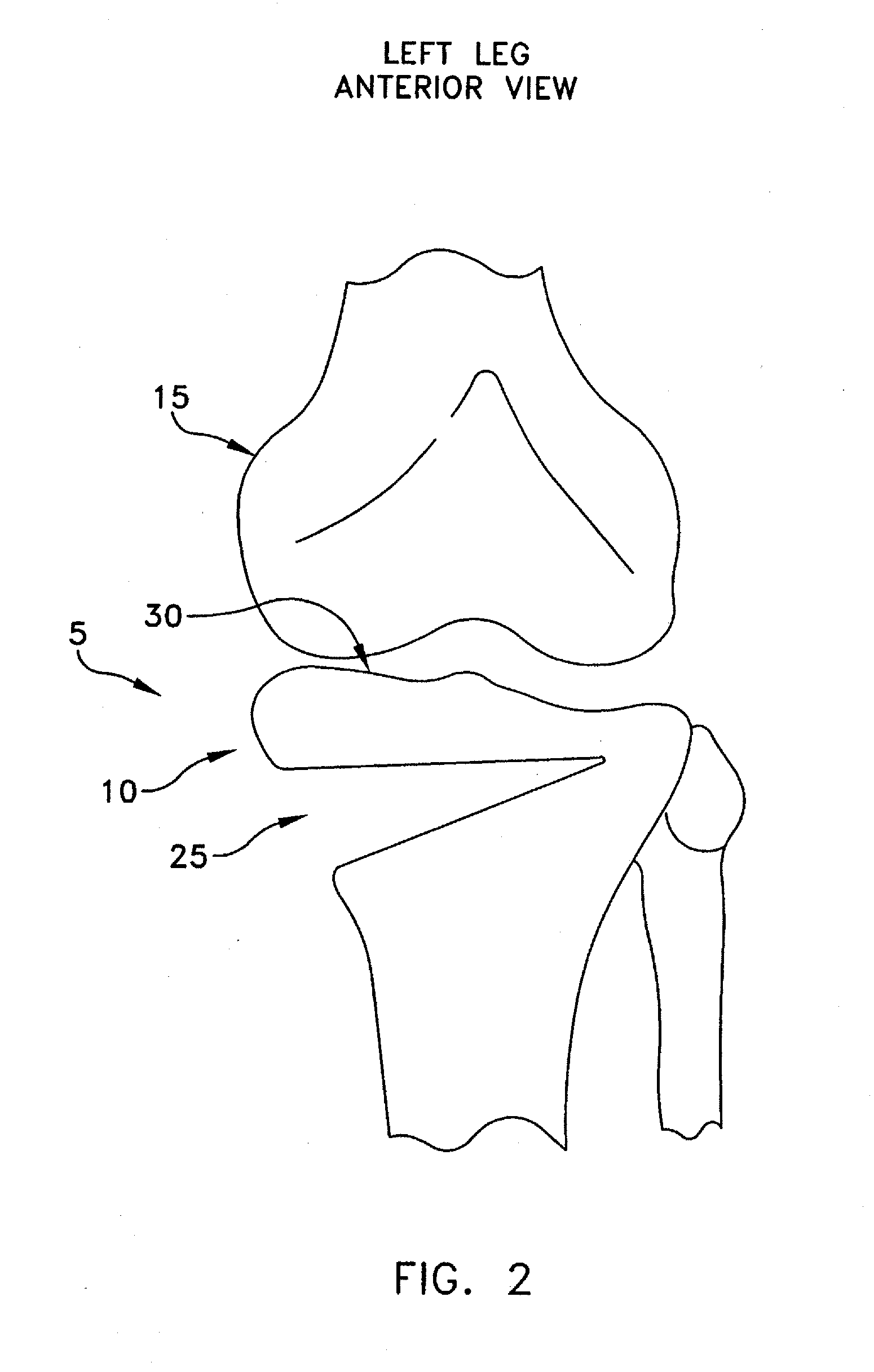 Method and apparatus for performing an osteotomy in bone
