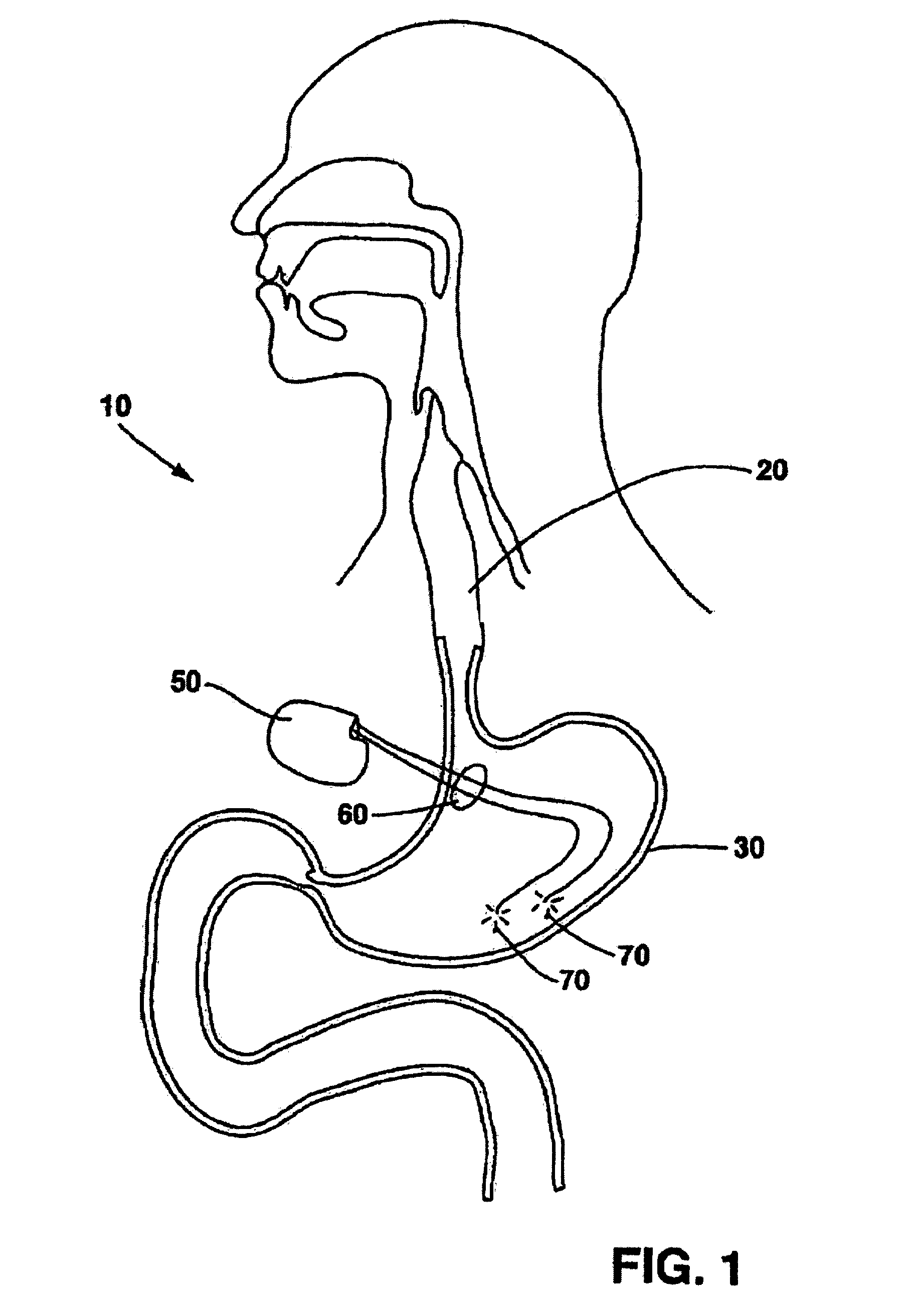 Implantable medical device with captivation fixation