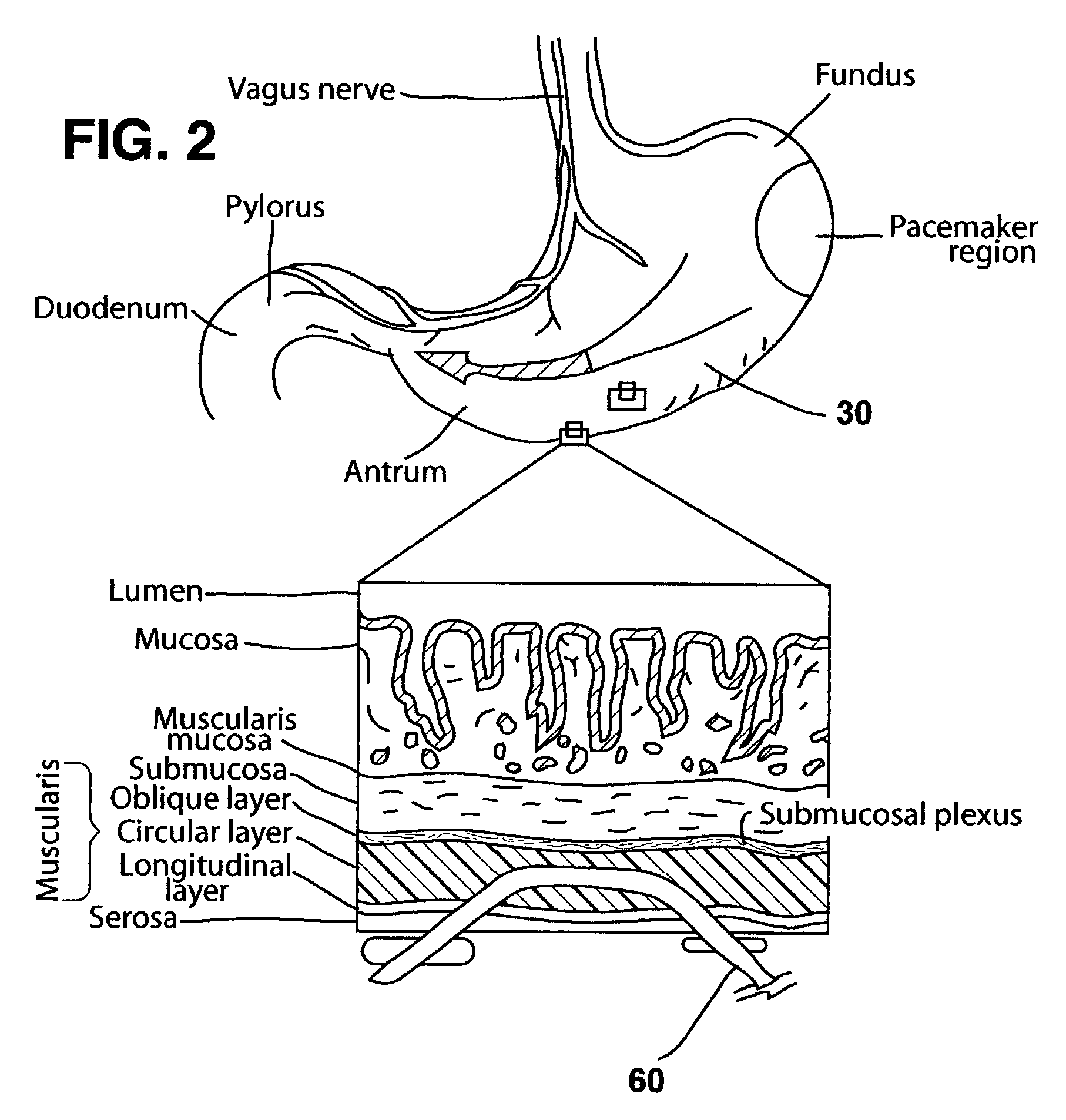 Implantable medical device with captivation fixation