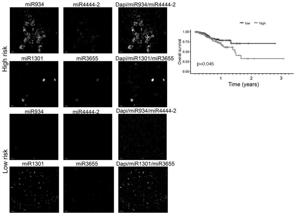 Kit for detecting prognosis condition of pancreatic cancer