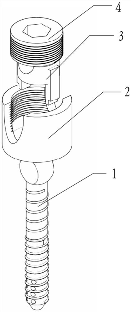 Pelvic fracture front ring fixing detachable screw and internal fixing device
