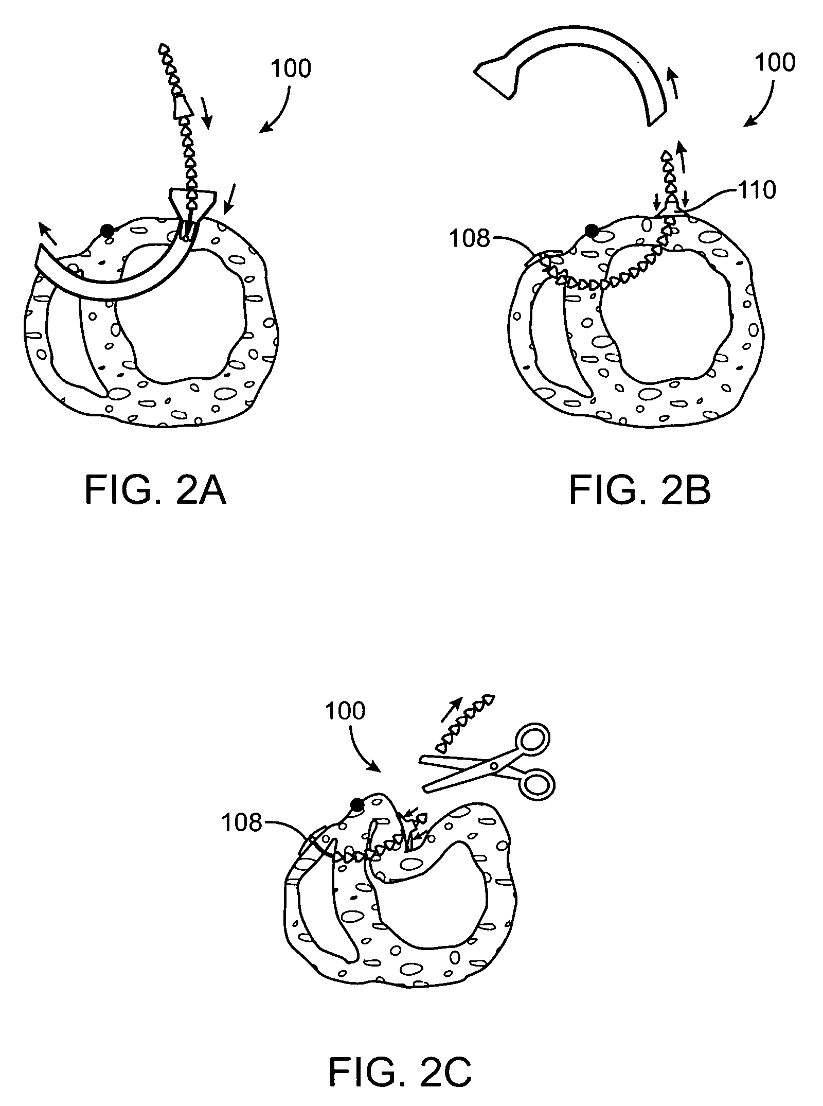 Method and apparatus for closing off a portion of a heart ventricle