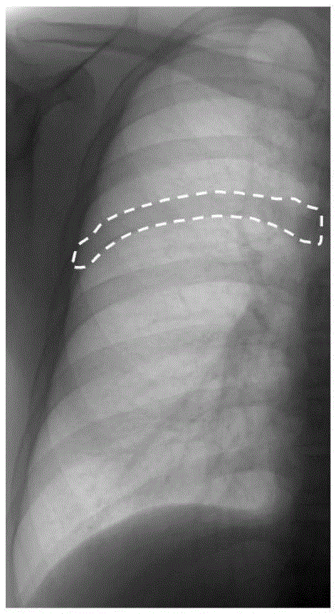 Method and system for inhibiting bone shadows in digital X ray chest radiograph