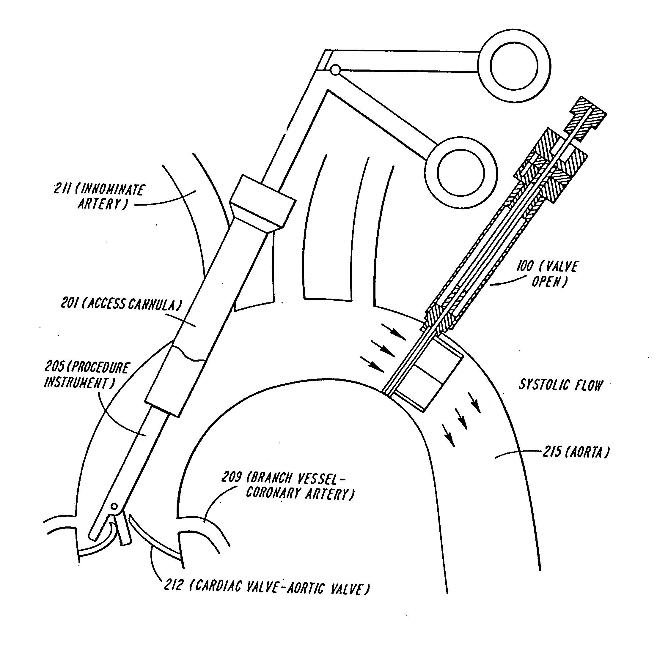 Cardiac valve procedure methods and devices