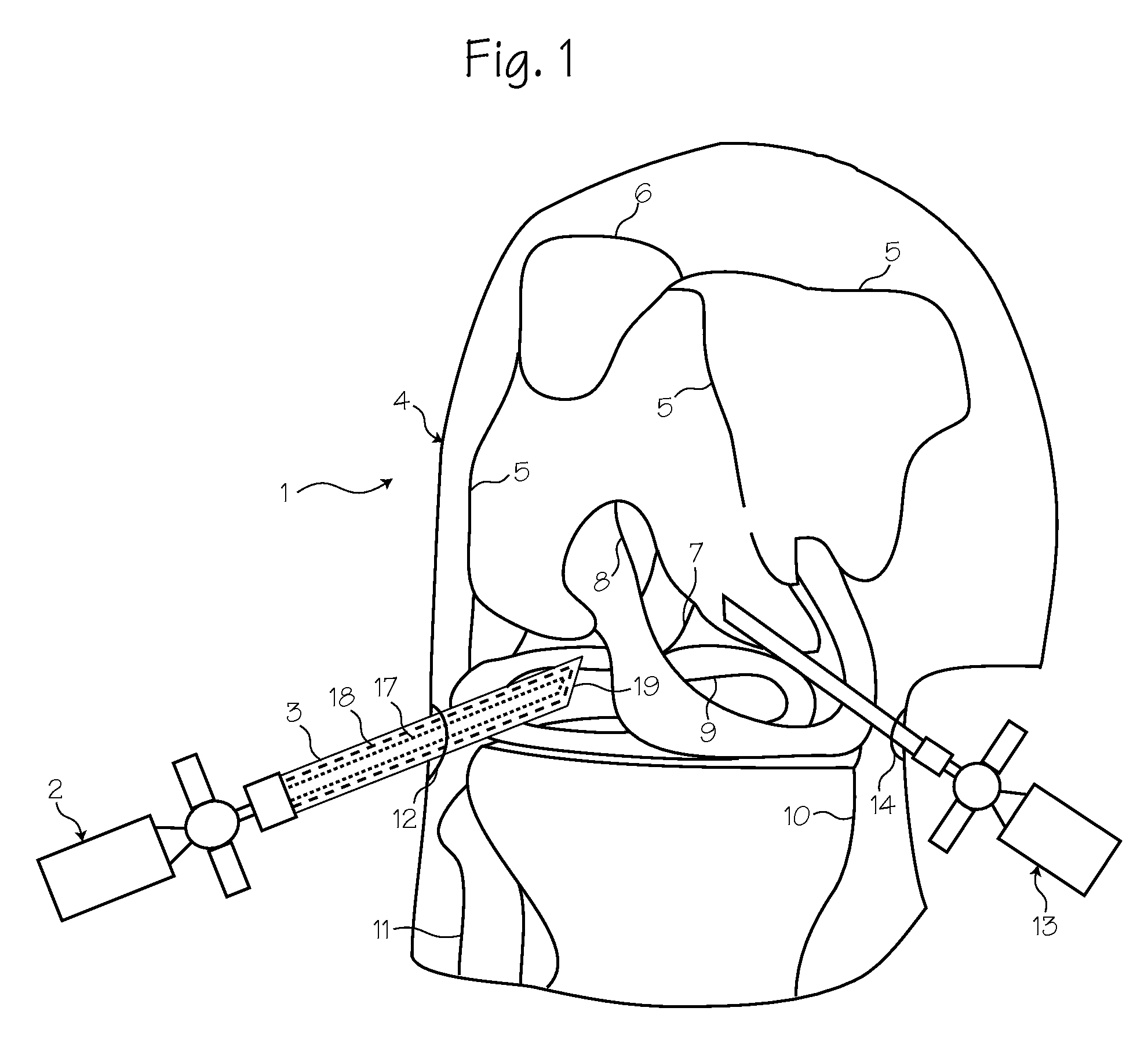 Rigid Arthroscope System