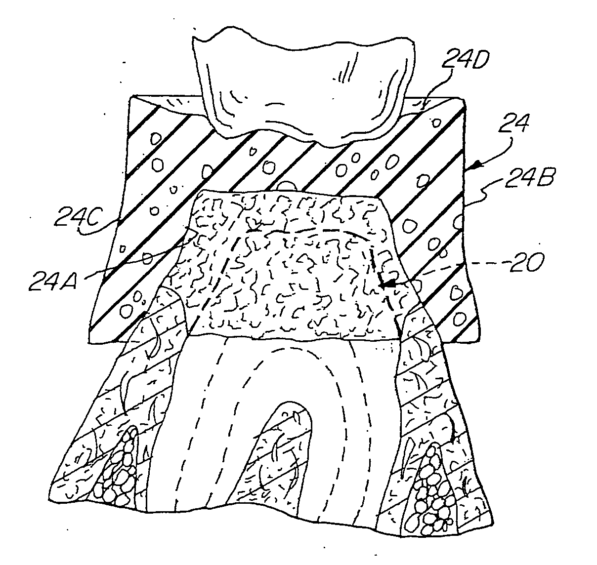 Method and device for the retraction and hemostasis of tissue during crown and bridge procedures