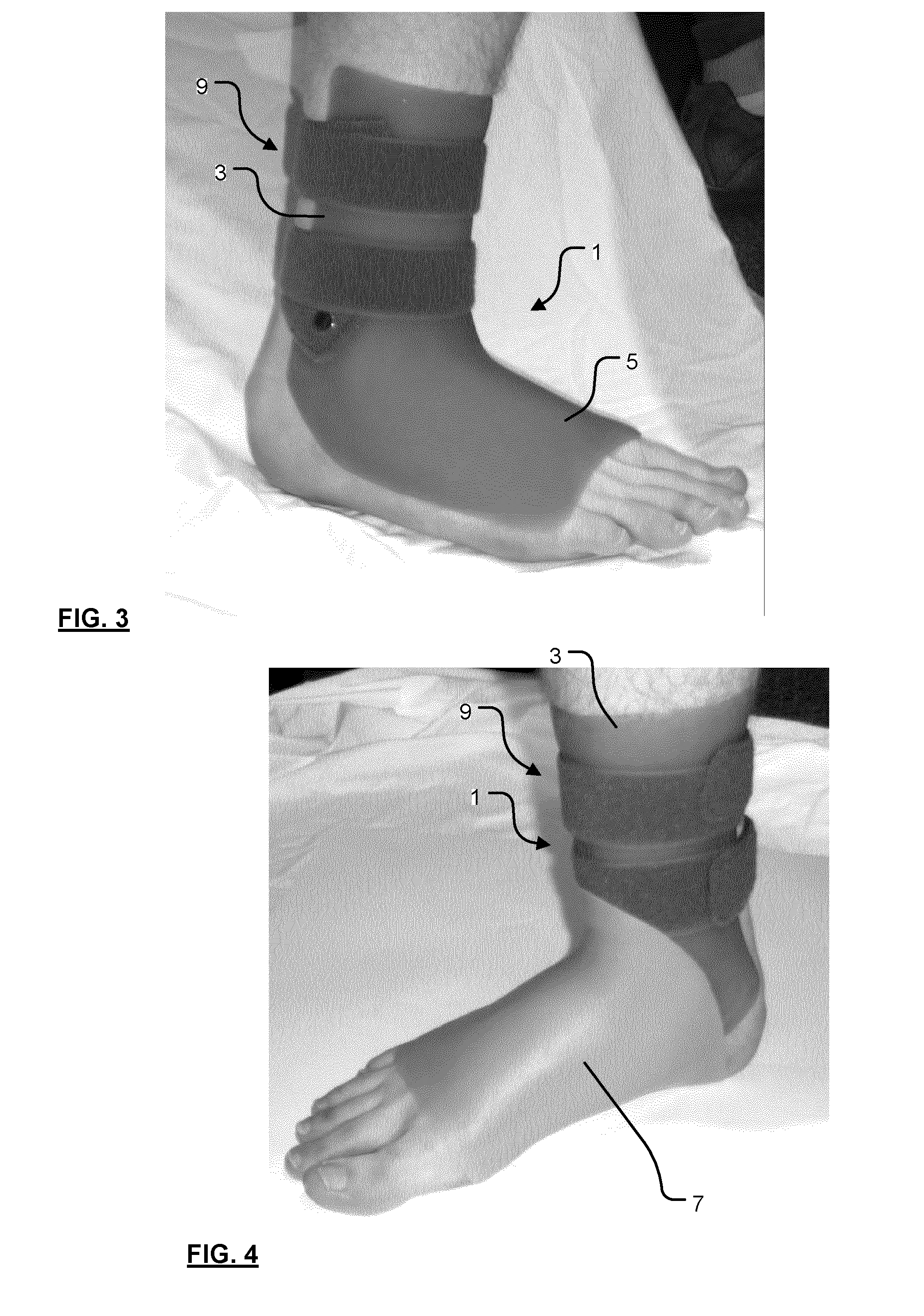 Ankle-foot orthoses