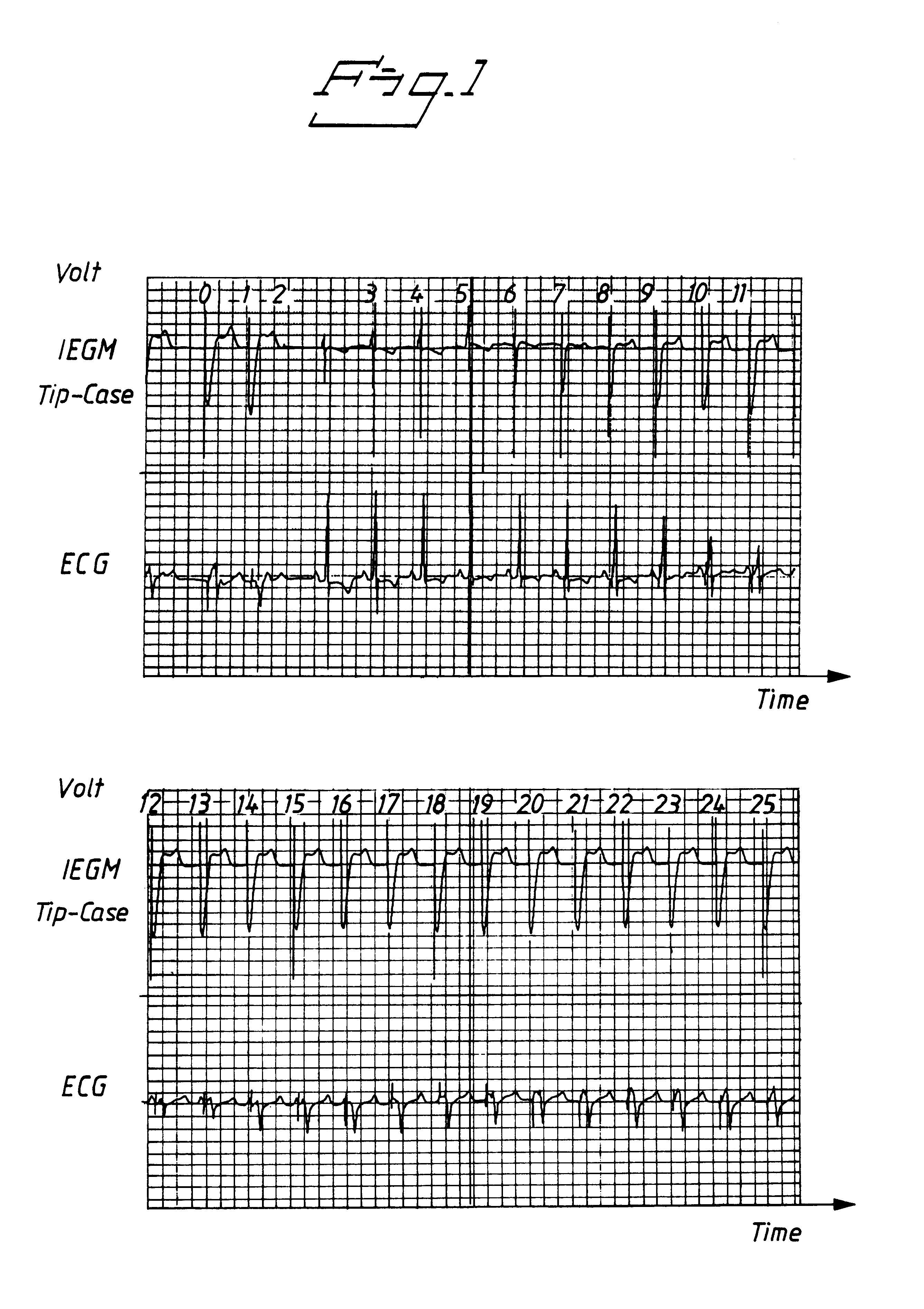 Evoked response detector, averaging the value of the amplitude of the picked-up electrode signal