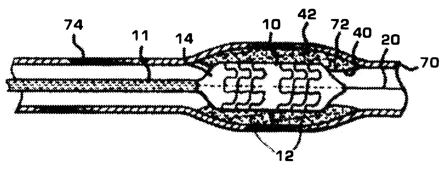 Stent with unconnected stent segments