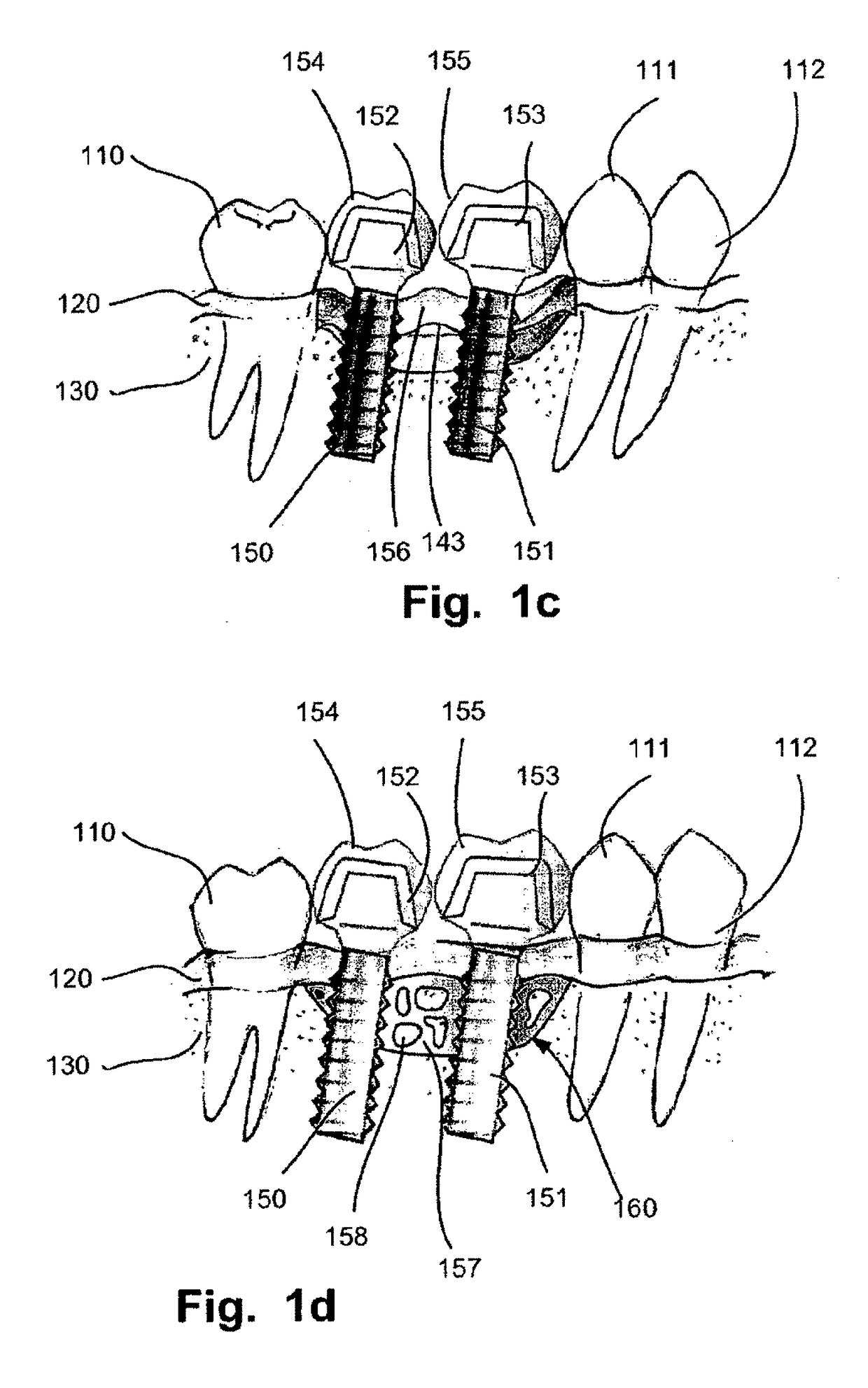 Computer implemented planning and providing of mass customized bone structure