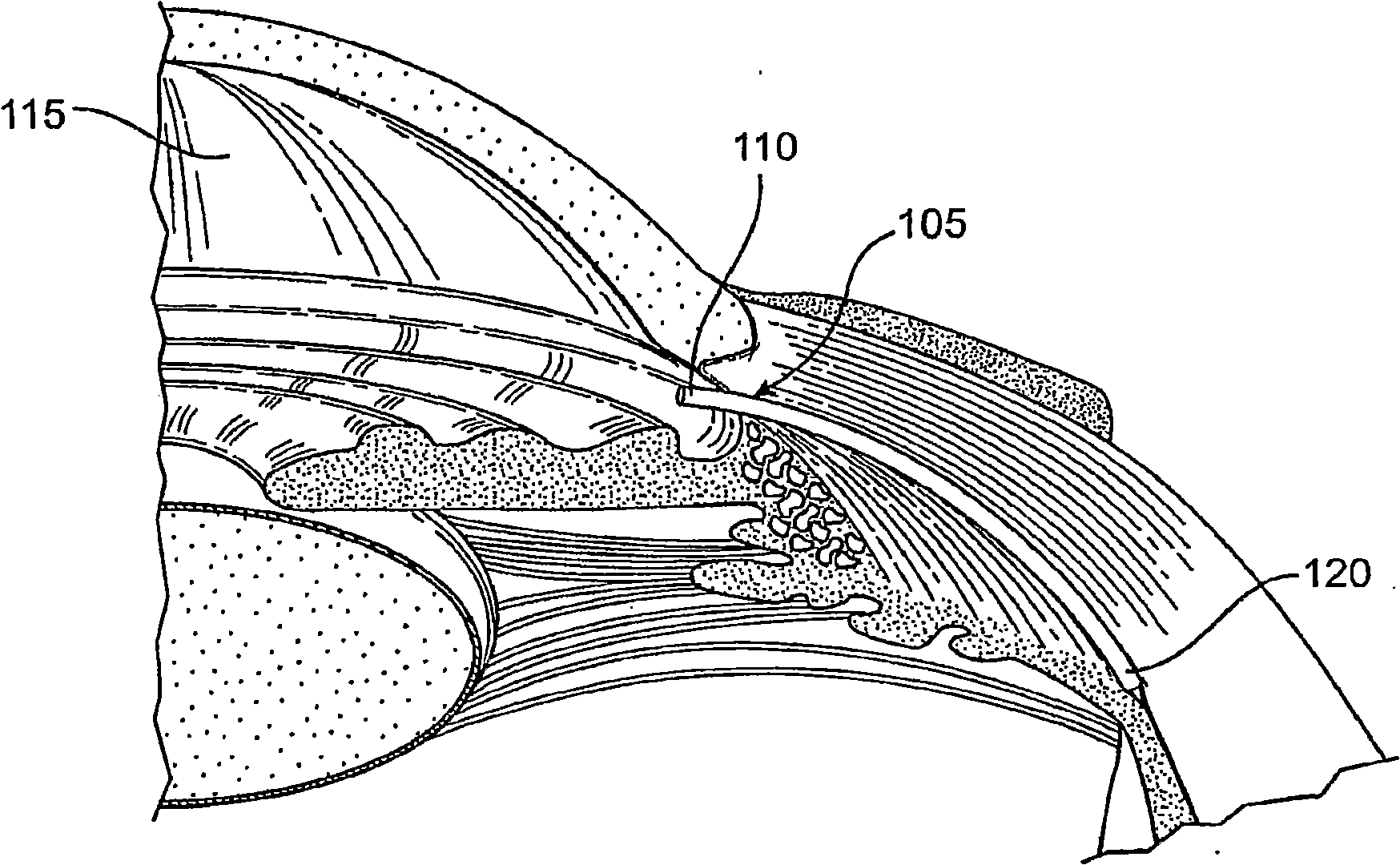 Glaucoma treatment device