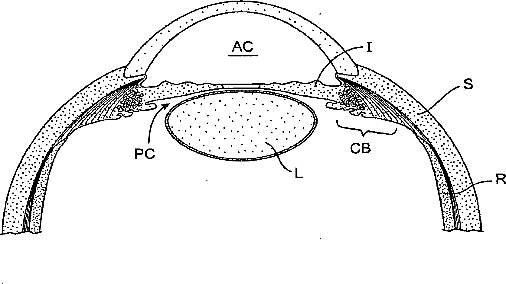 Glaucoma treatment device