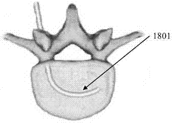 Device for forming cavity in centrum