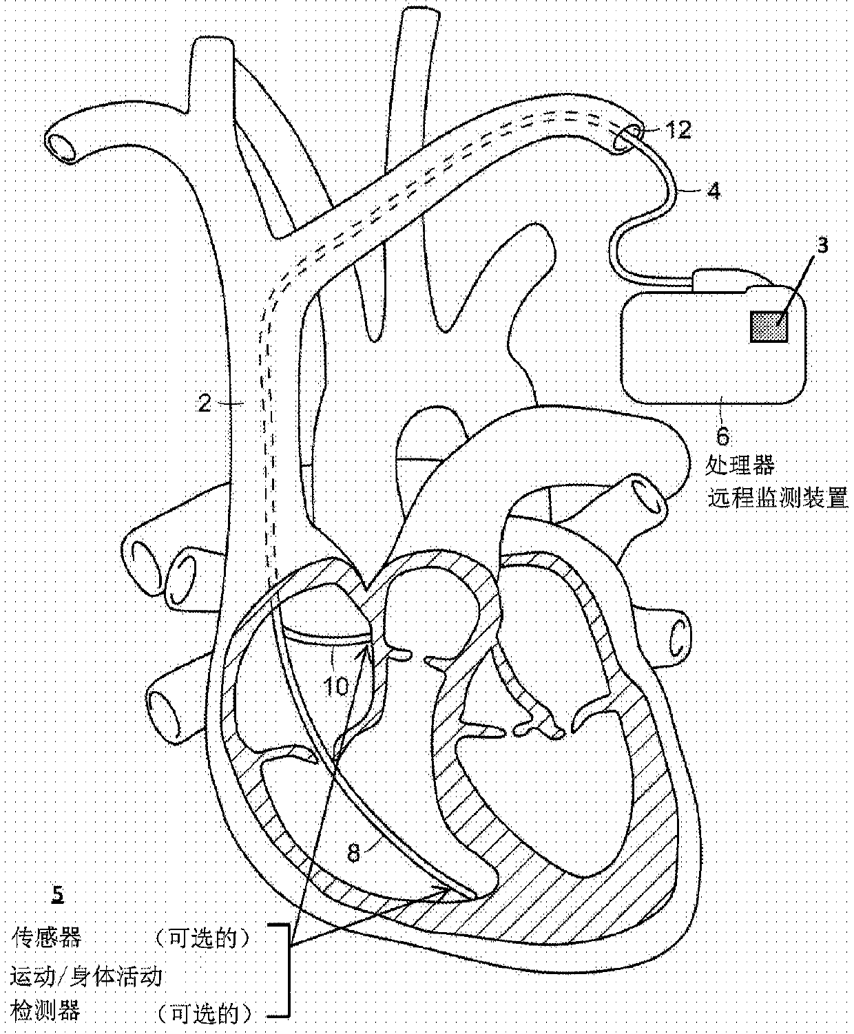 Techniques for heart muscle remodeling using a cardiac pacemaker and related systems and methods