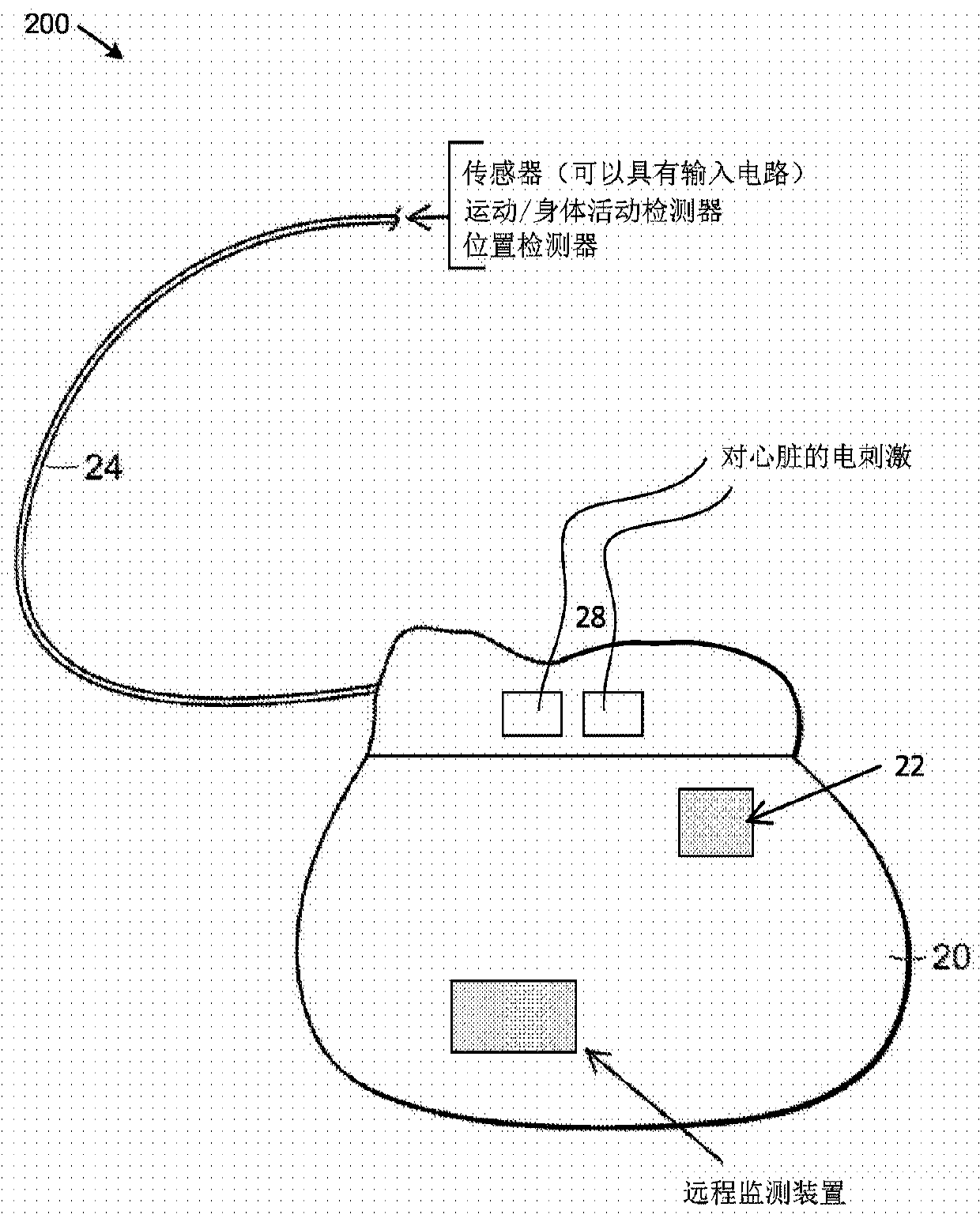 Techniques for heart muscle remodeling using a cardiac pacemaker and related systems and methods