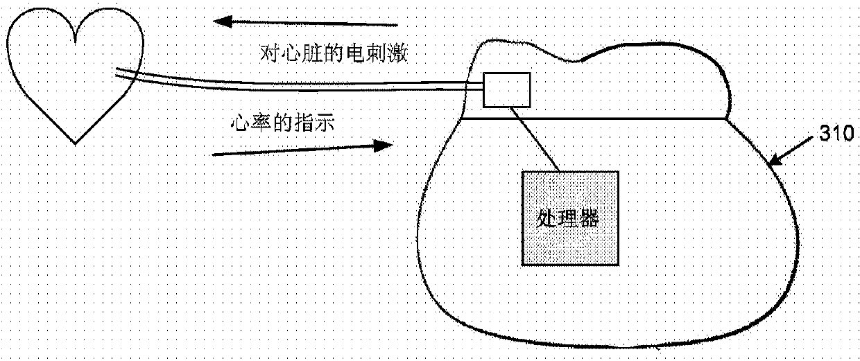 Techniques for heart muscle remodeling using a cardiac pacemaker and related systems and methods