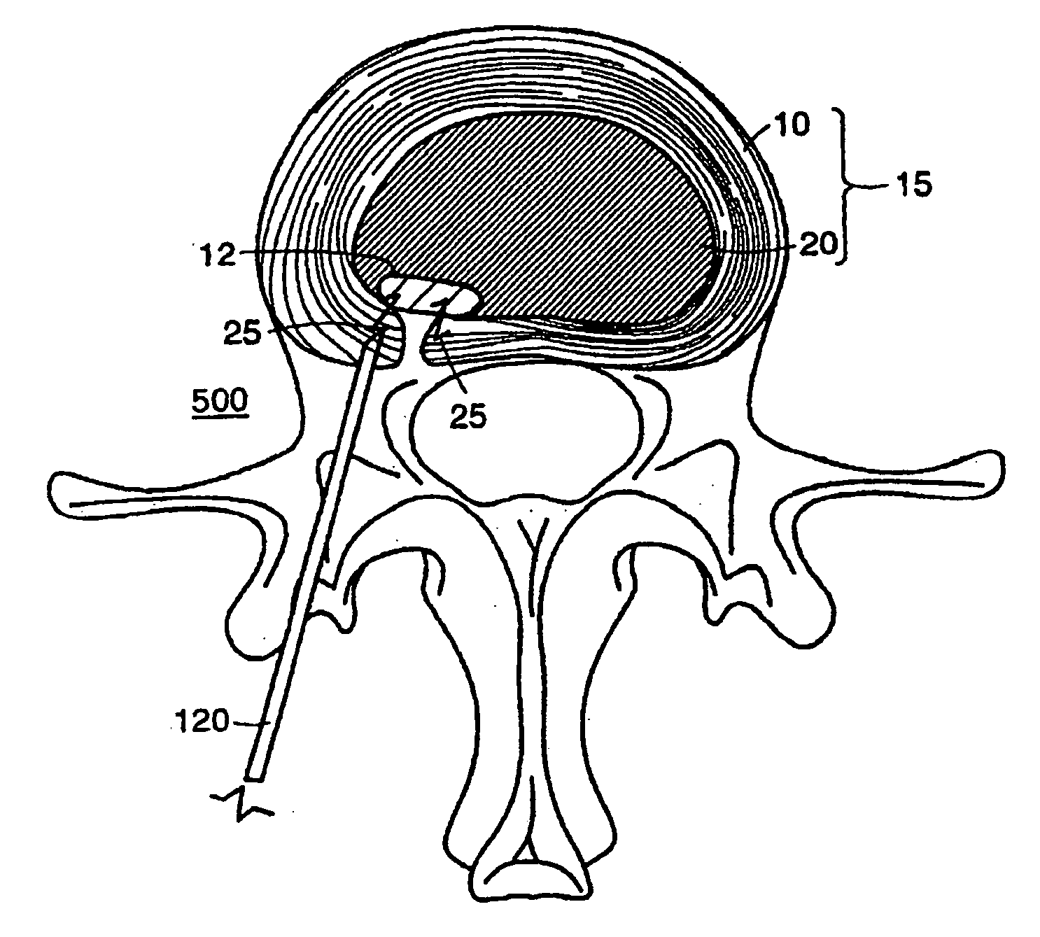 Intervertebral anulus and nucleus augmentation