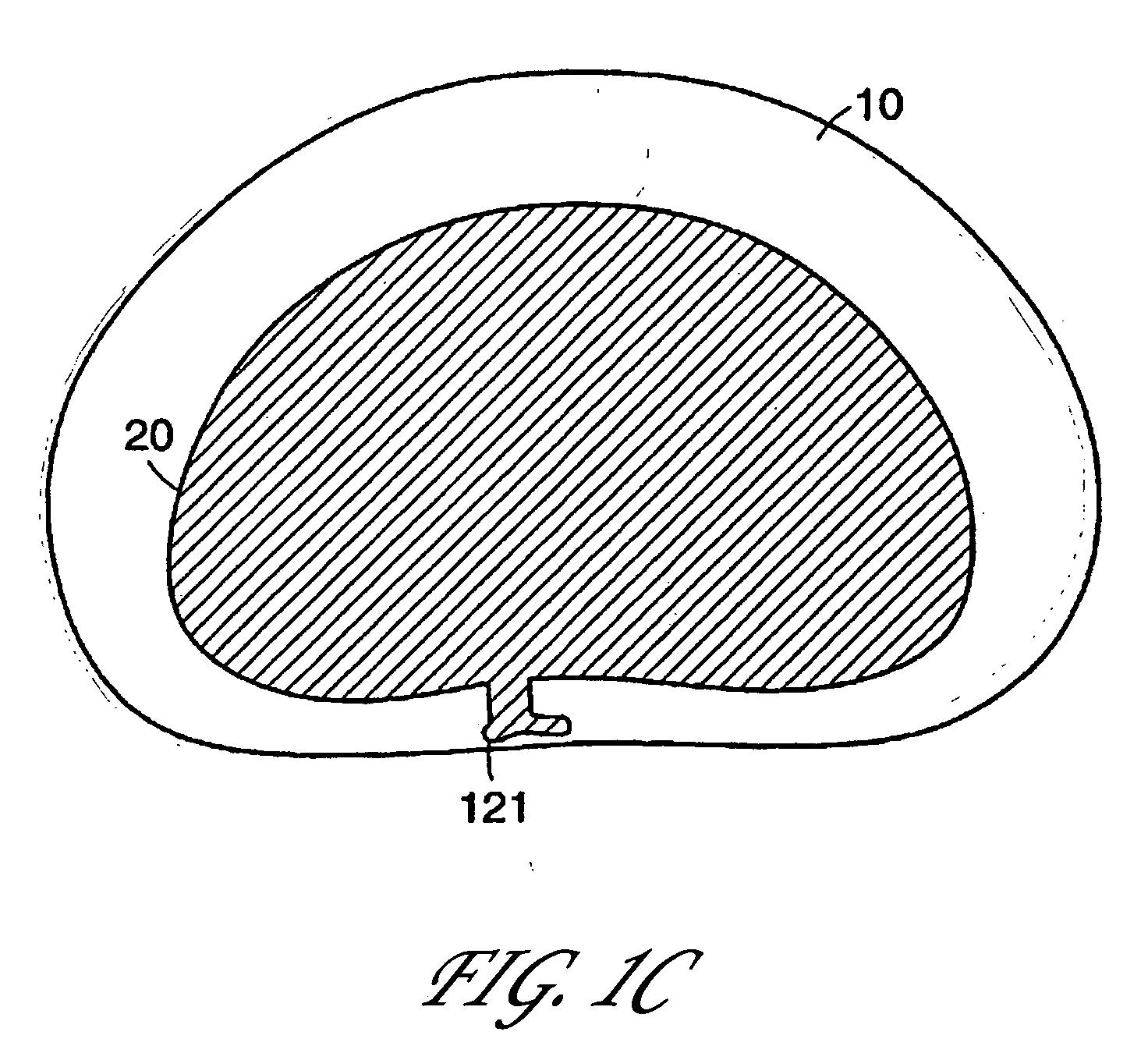 Intervertebral anulus and nucleus augmentation