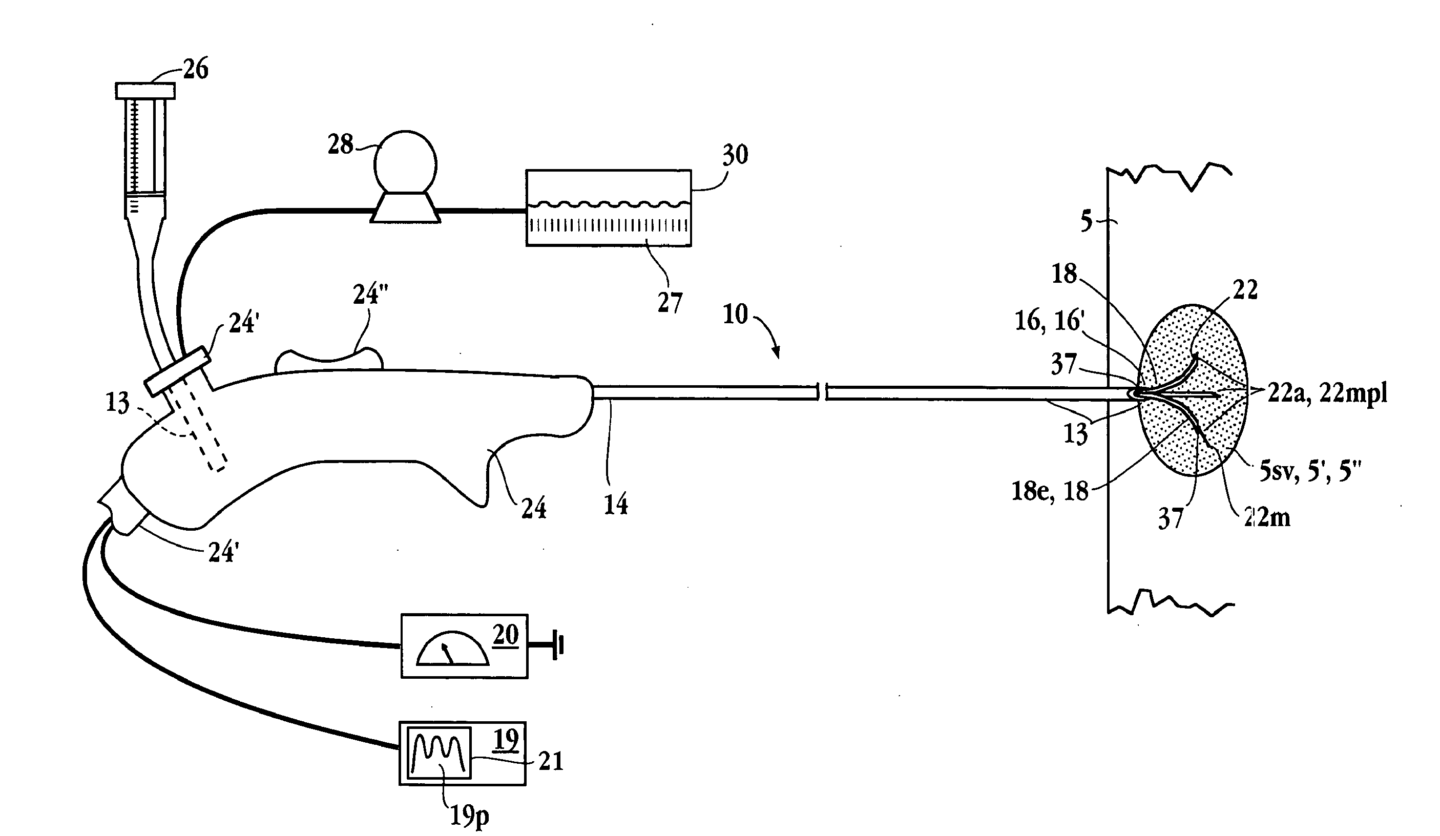 Tissue ablation apparatus and method