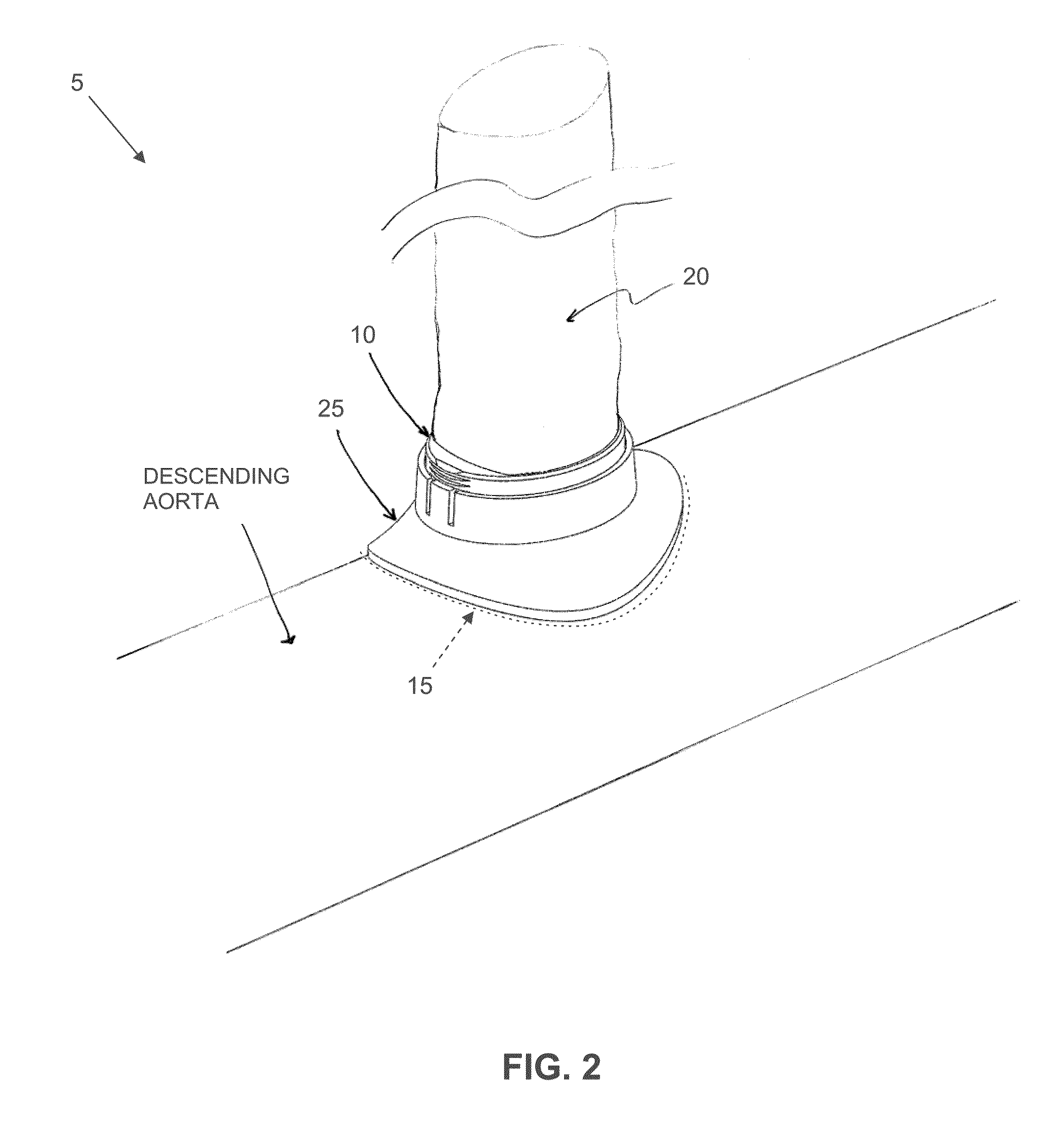 Method and apparatus for effecting a minimally invasive distal anastomosis for an aortic valve bypass