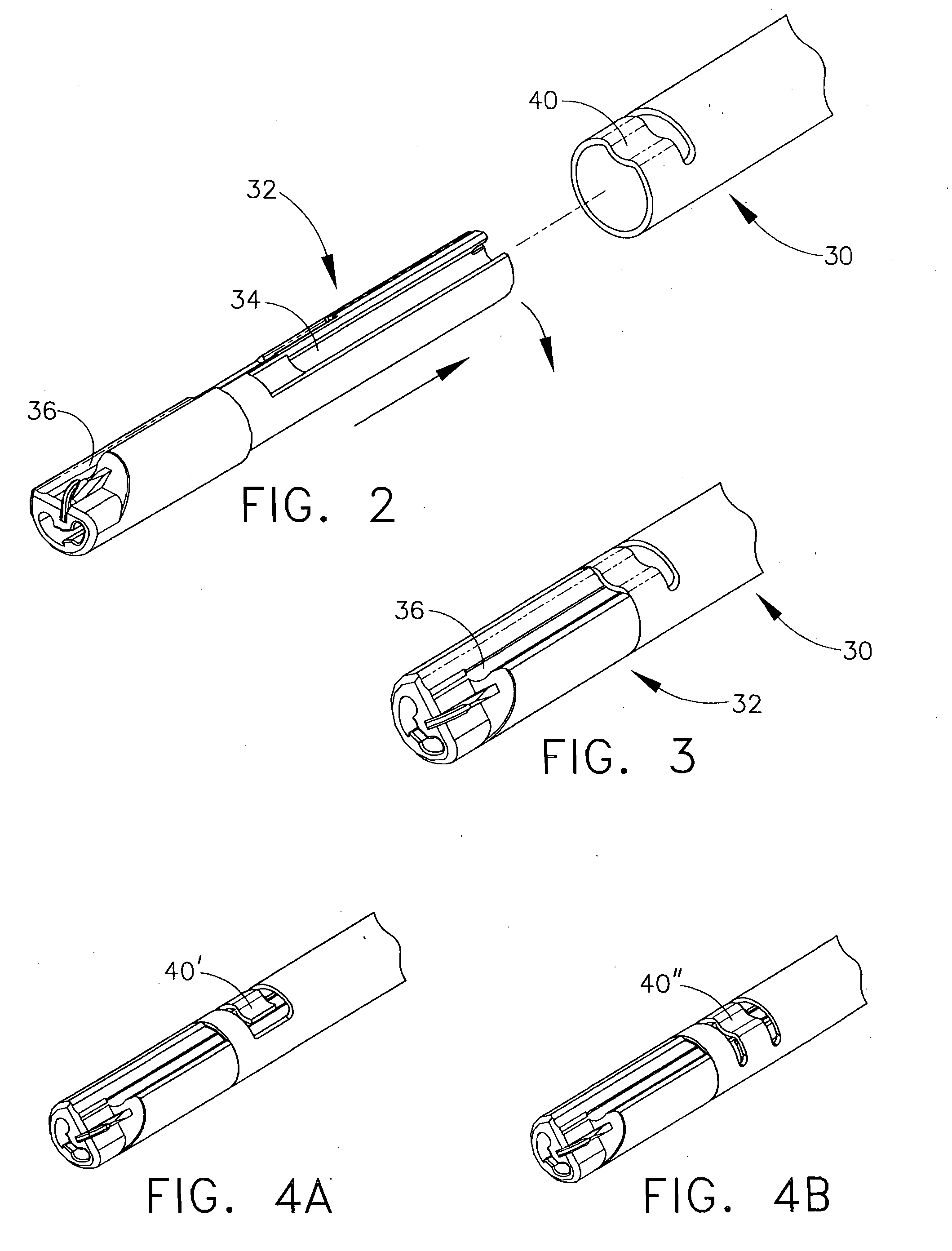 Method for Deploying A Device For Gastric Volume Reduction