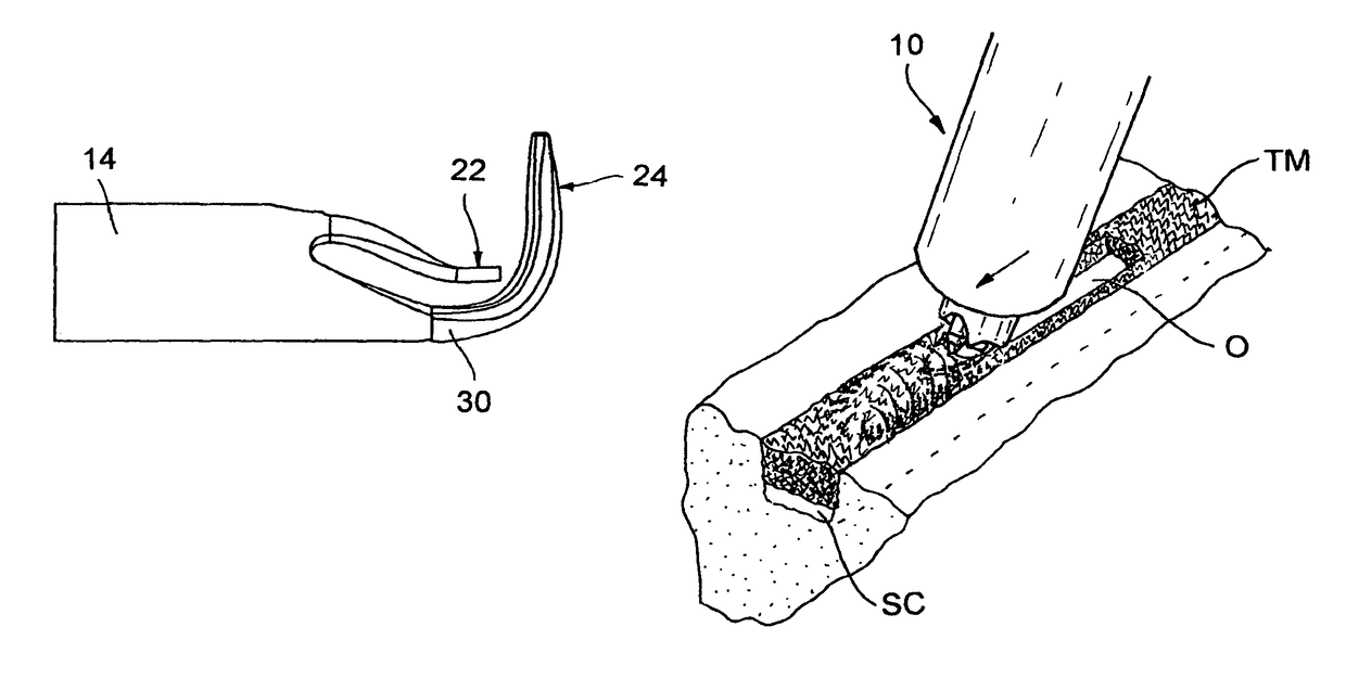 Devices useable for treatment of glaucoma and other surgical procedures