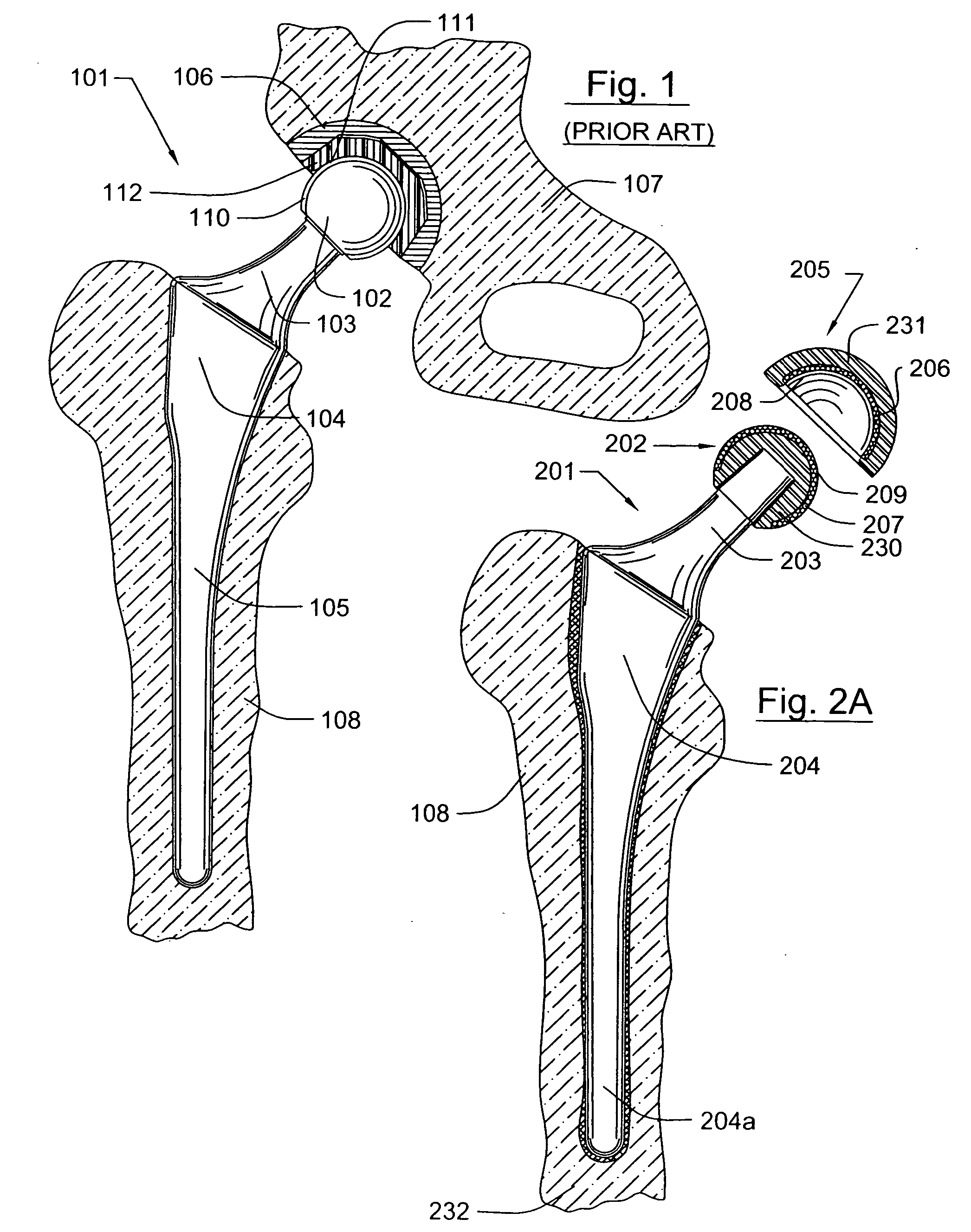 Prosthetic joint component having at least one sintered polycrystalline diamond compact articulation surface and substrate surface topographical features in said polycrystalline diamond compact