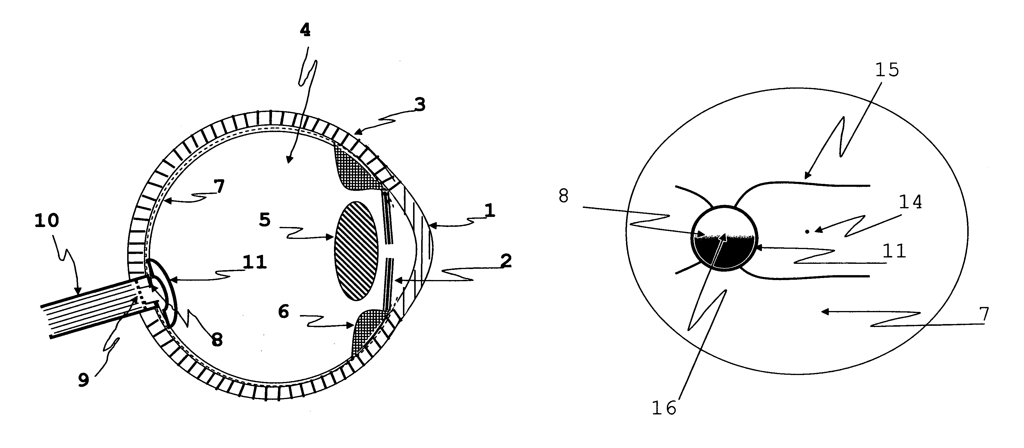 Apparatus and method for preventing glaucomatous optic neuropathy