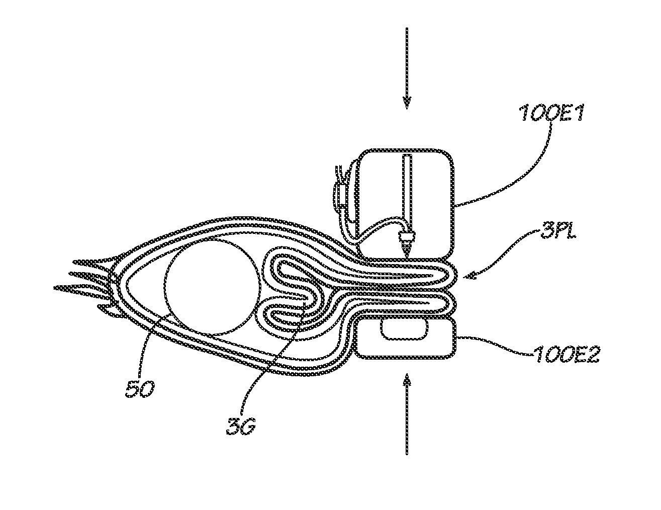 Methods, Instruments and Devices for Extragastric Reduction of Stomach Volume