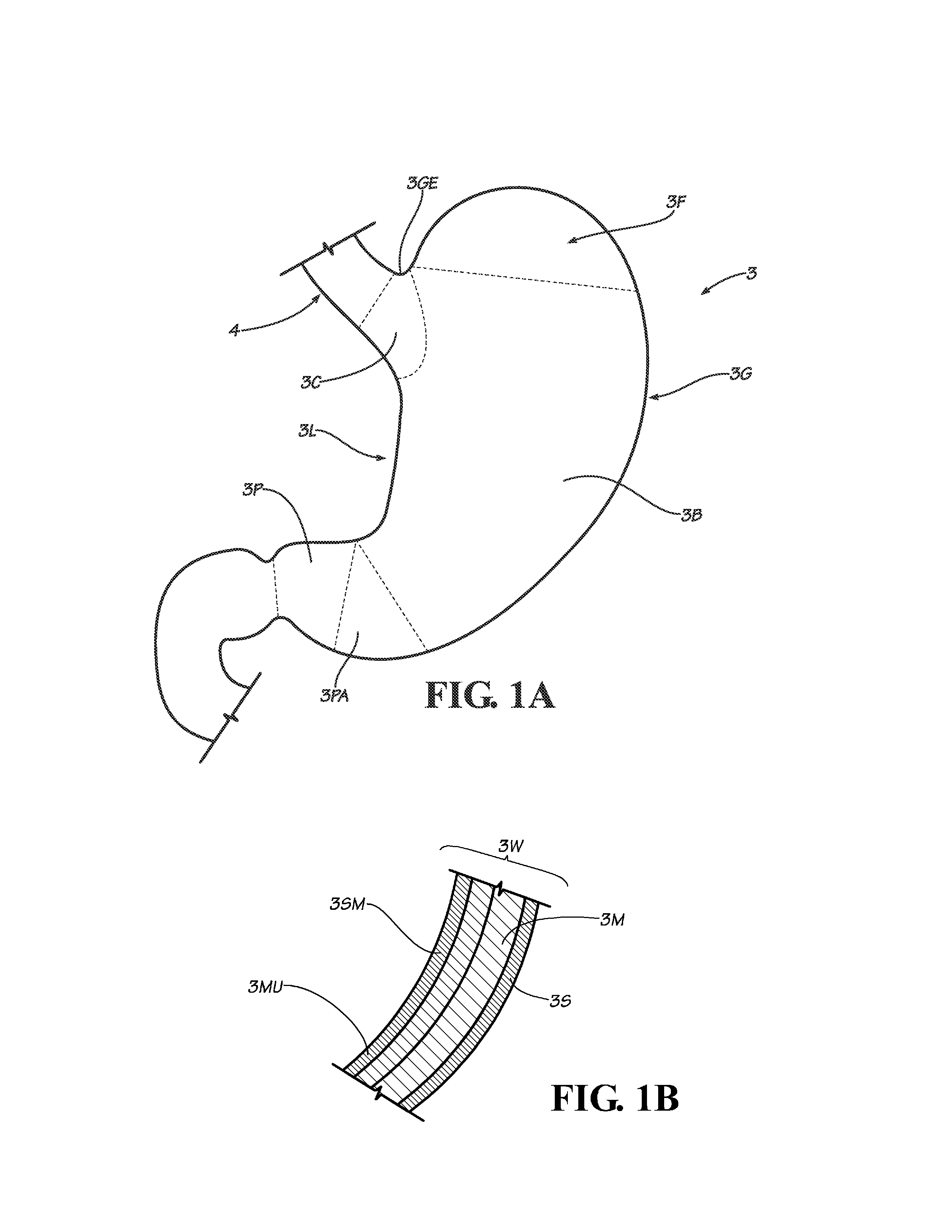Methods, Instruments and Devices for Extragastric Reduction of Stomach Volume