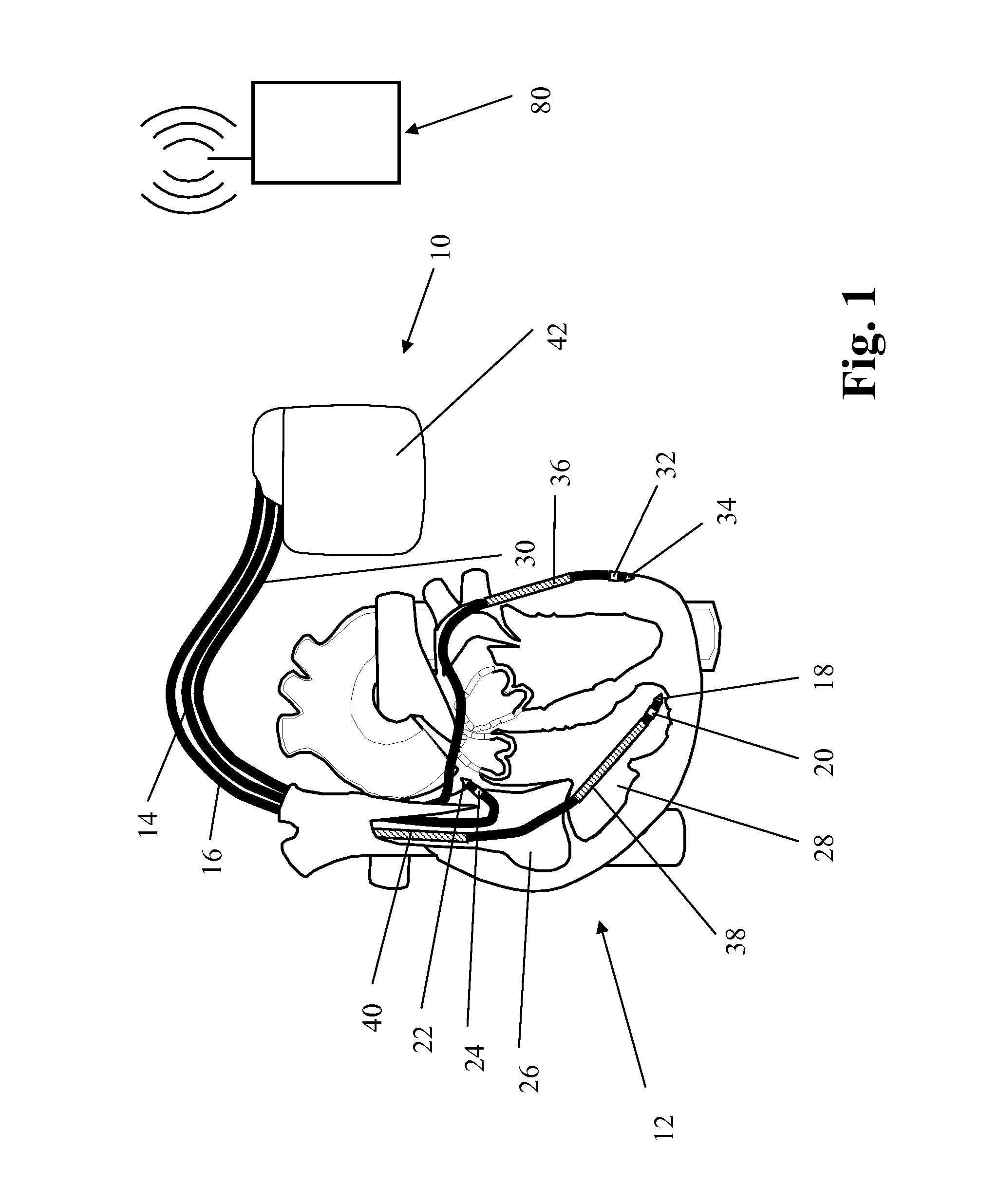 Apparatus and method to optimize pacing parameters