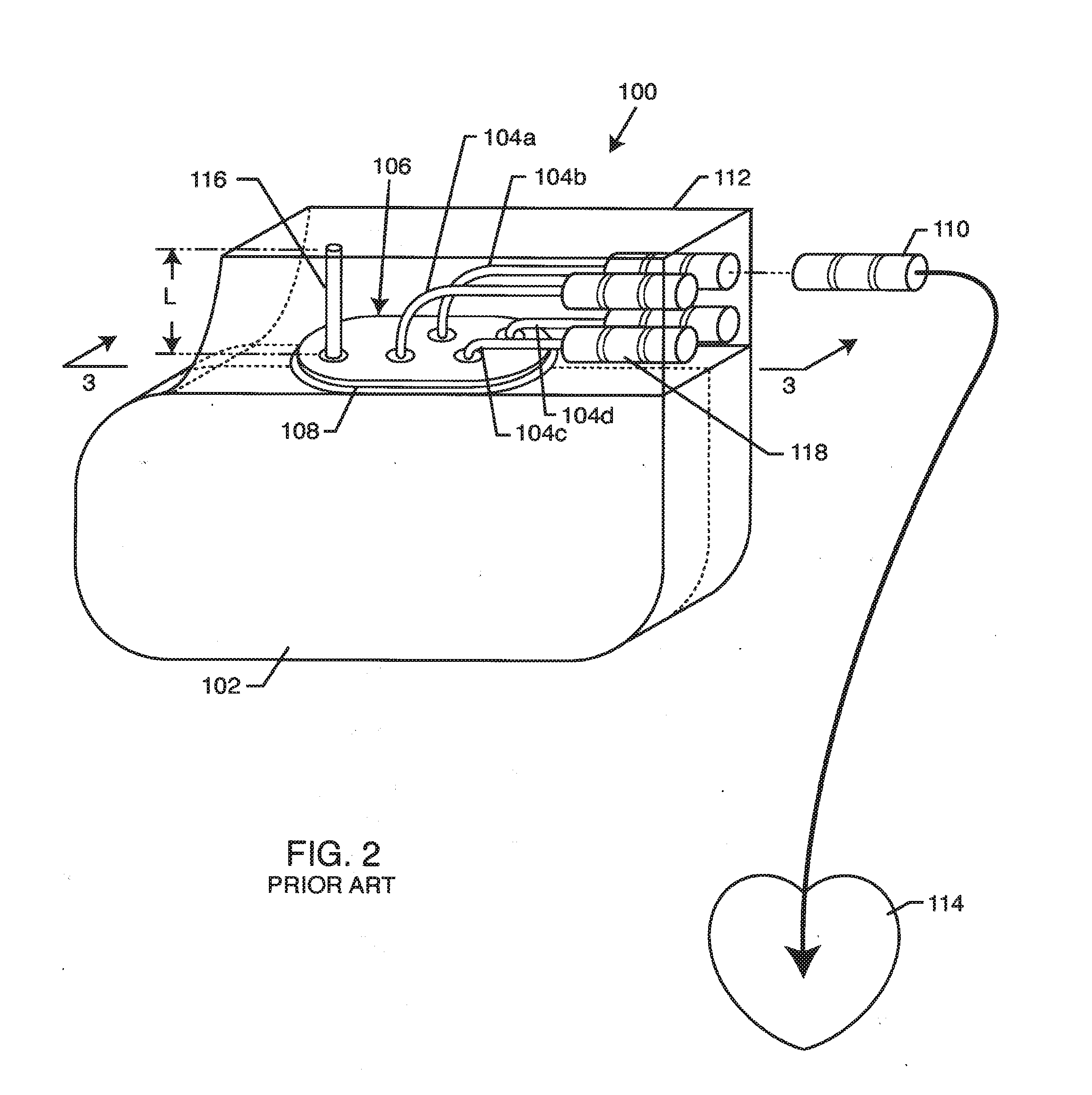 EMI filter employing a self-resonant inductor bandstop filter having optimum inductance and capacitance values