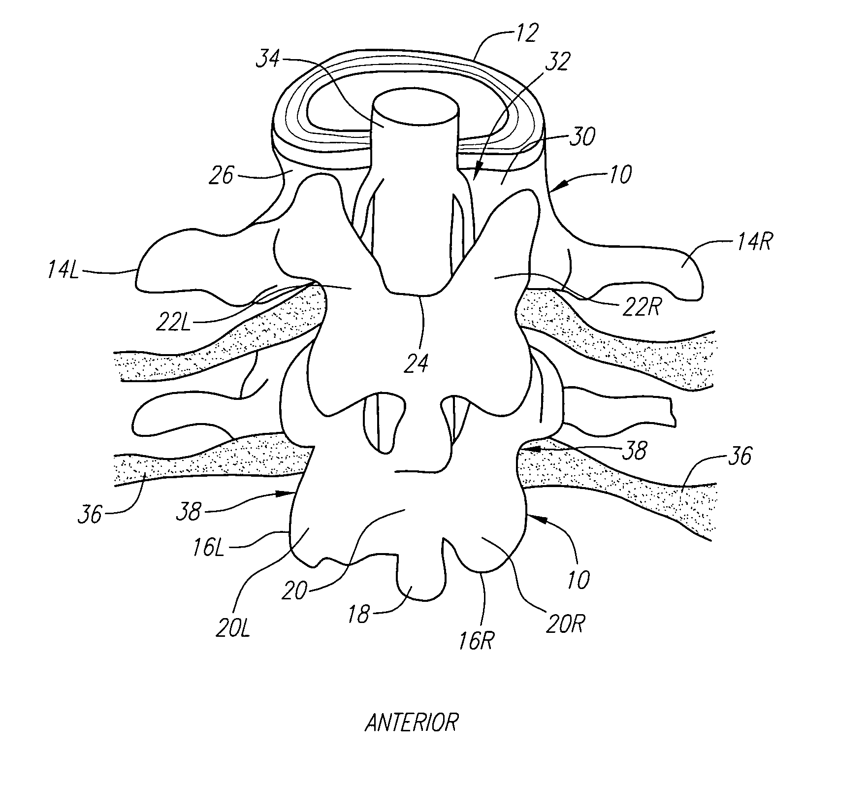 Radially adjustable tissue removal device