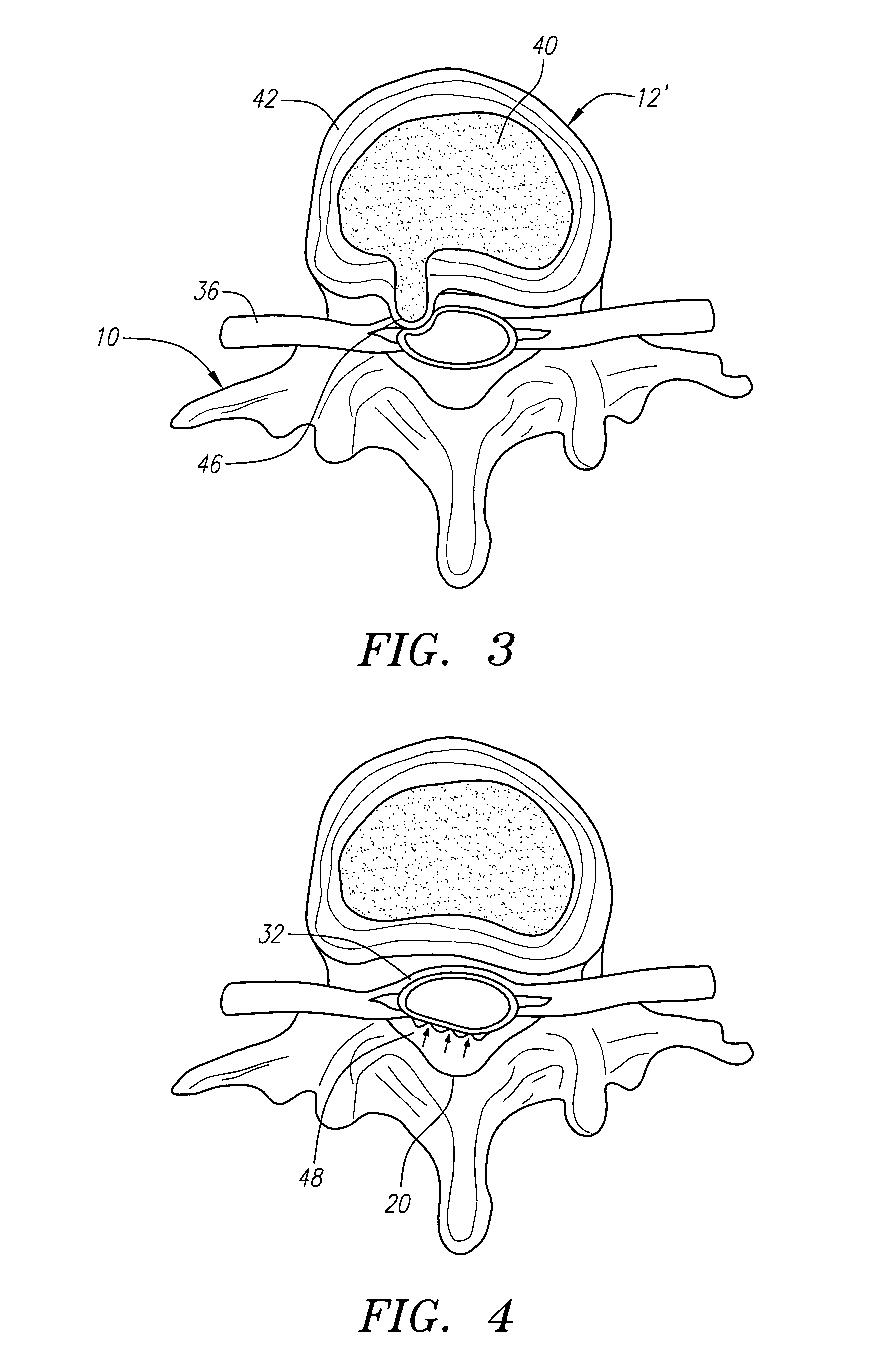 Radially adjustable tissue removal device