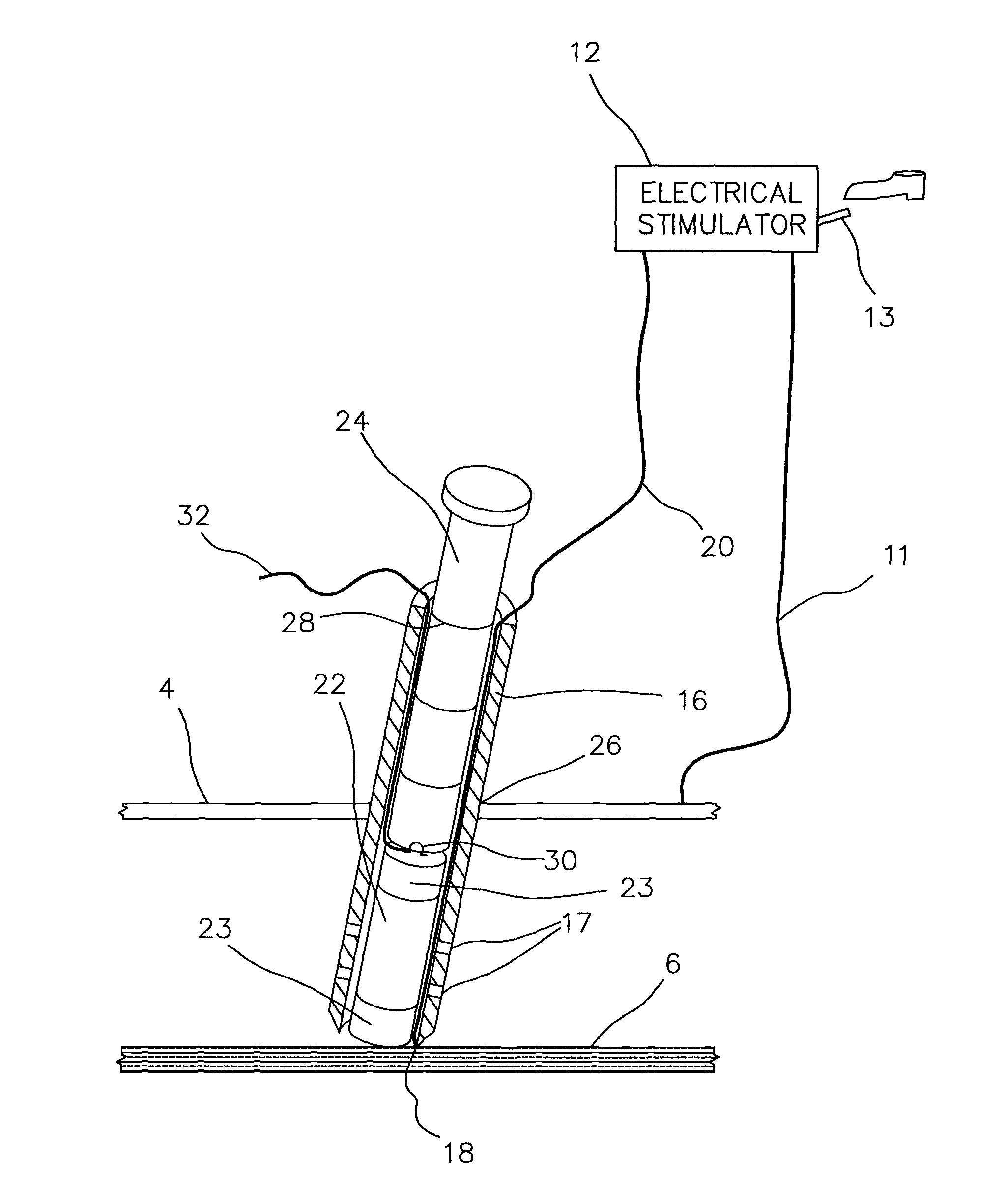 Method for removing surgically implanted devices