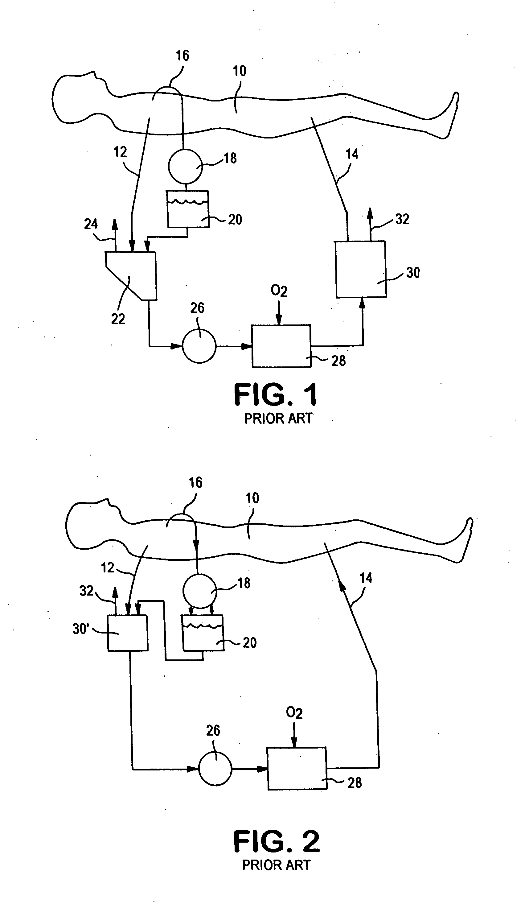 Active air removal from an extracorporeal blood circuit