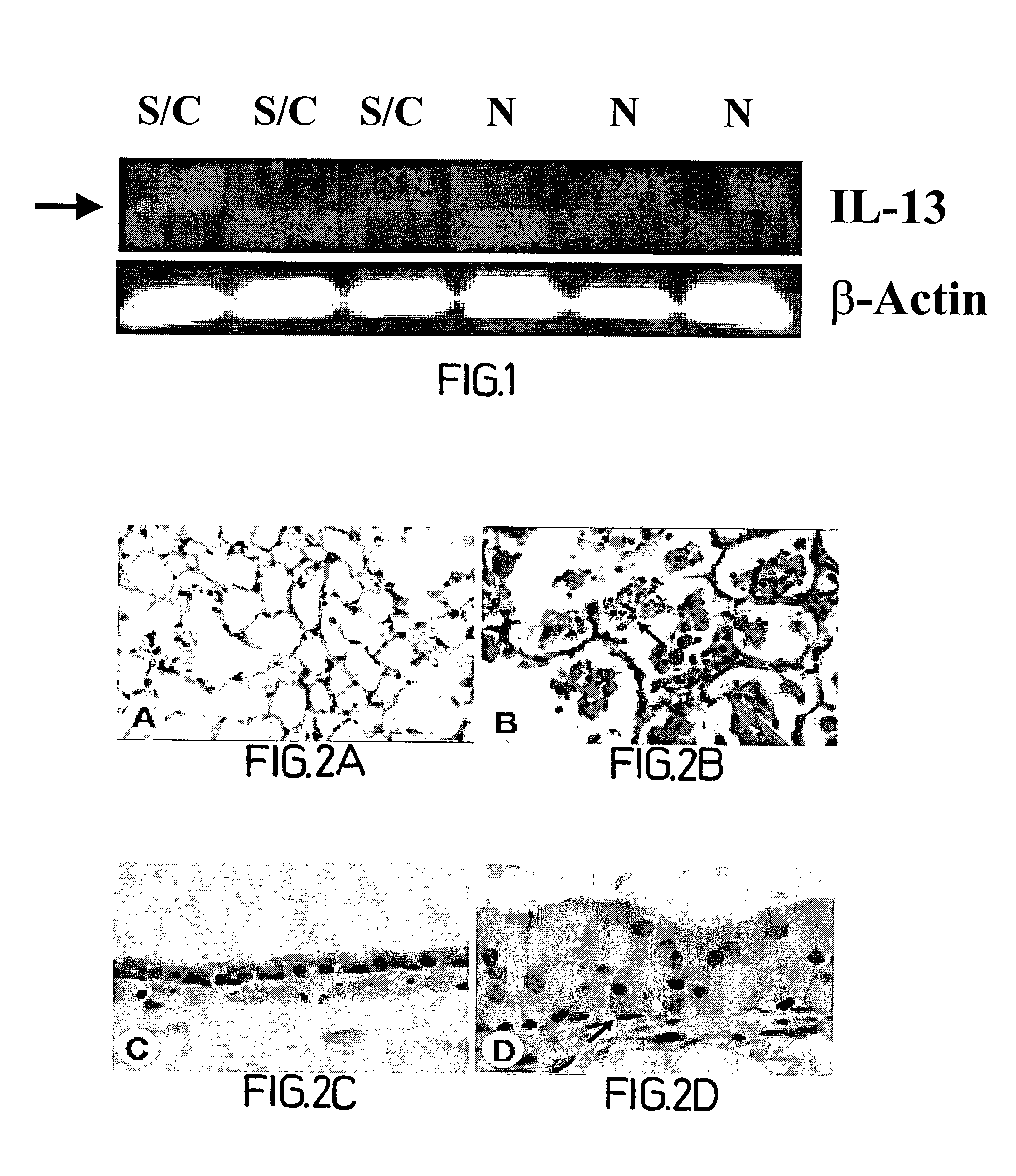 Methods, compositions and kits relating to chitinases and chitinase-like molecules and inflammatory disease