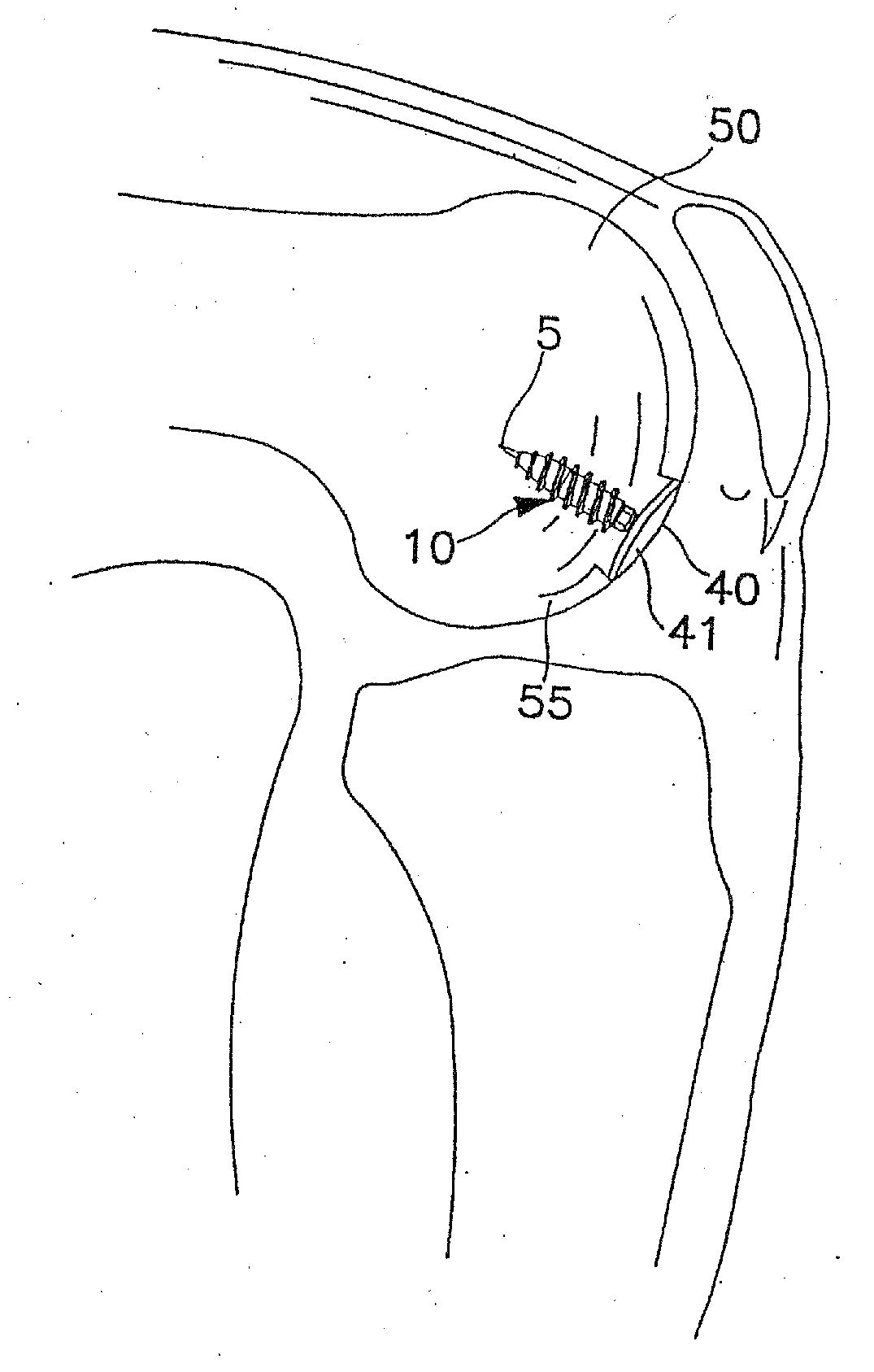 System and Method for Joint Resurface Repair