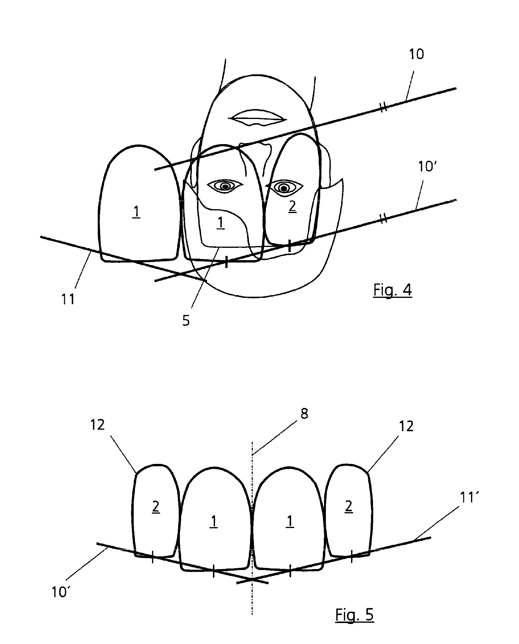 Method for reconstruction of teeth
